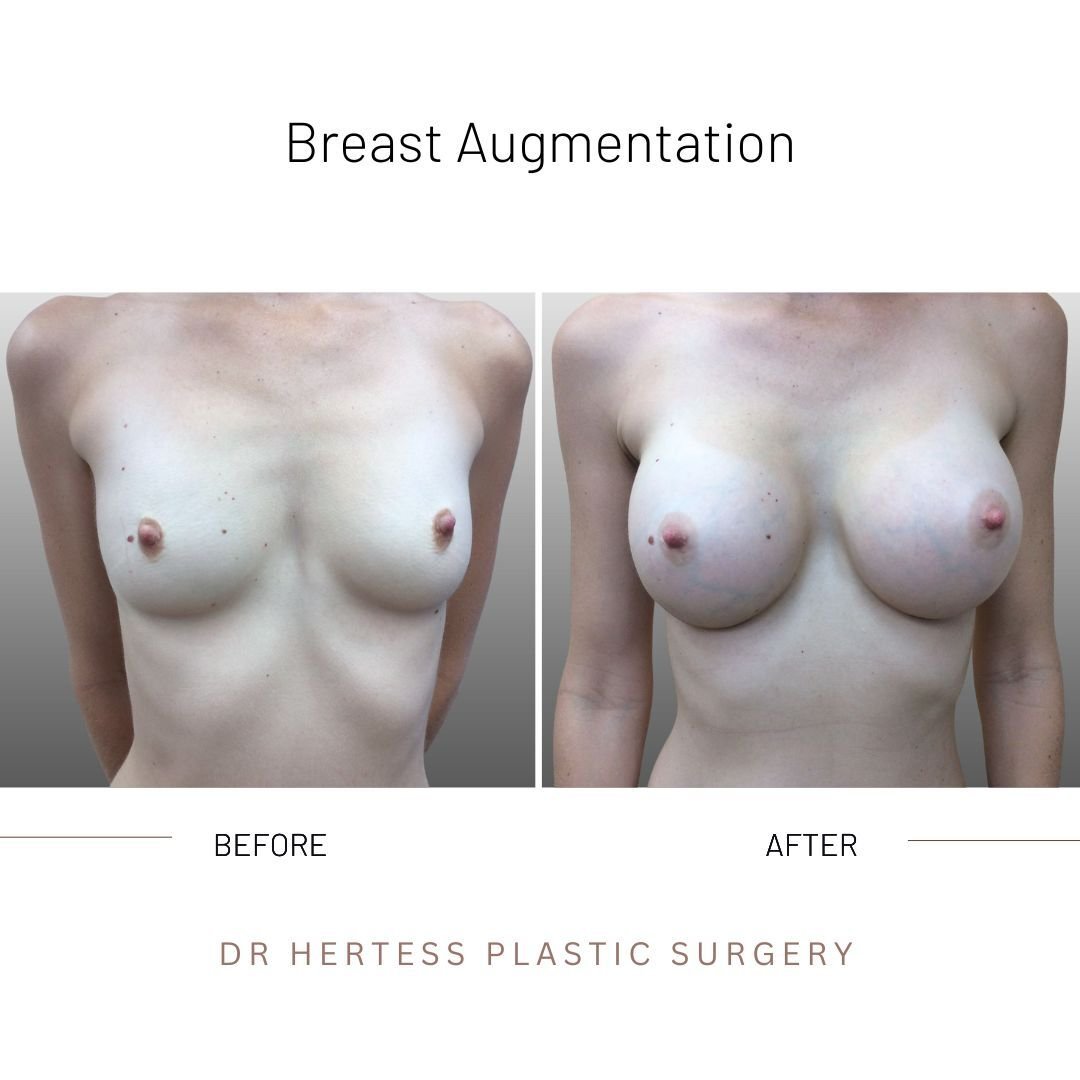 boob job before and after