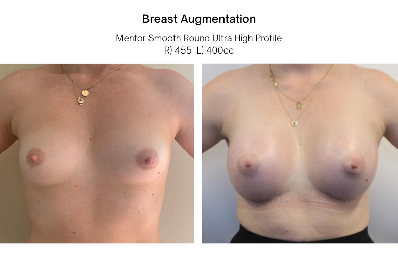 breast augmentation before and after