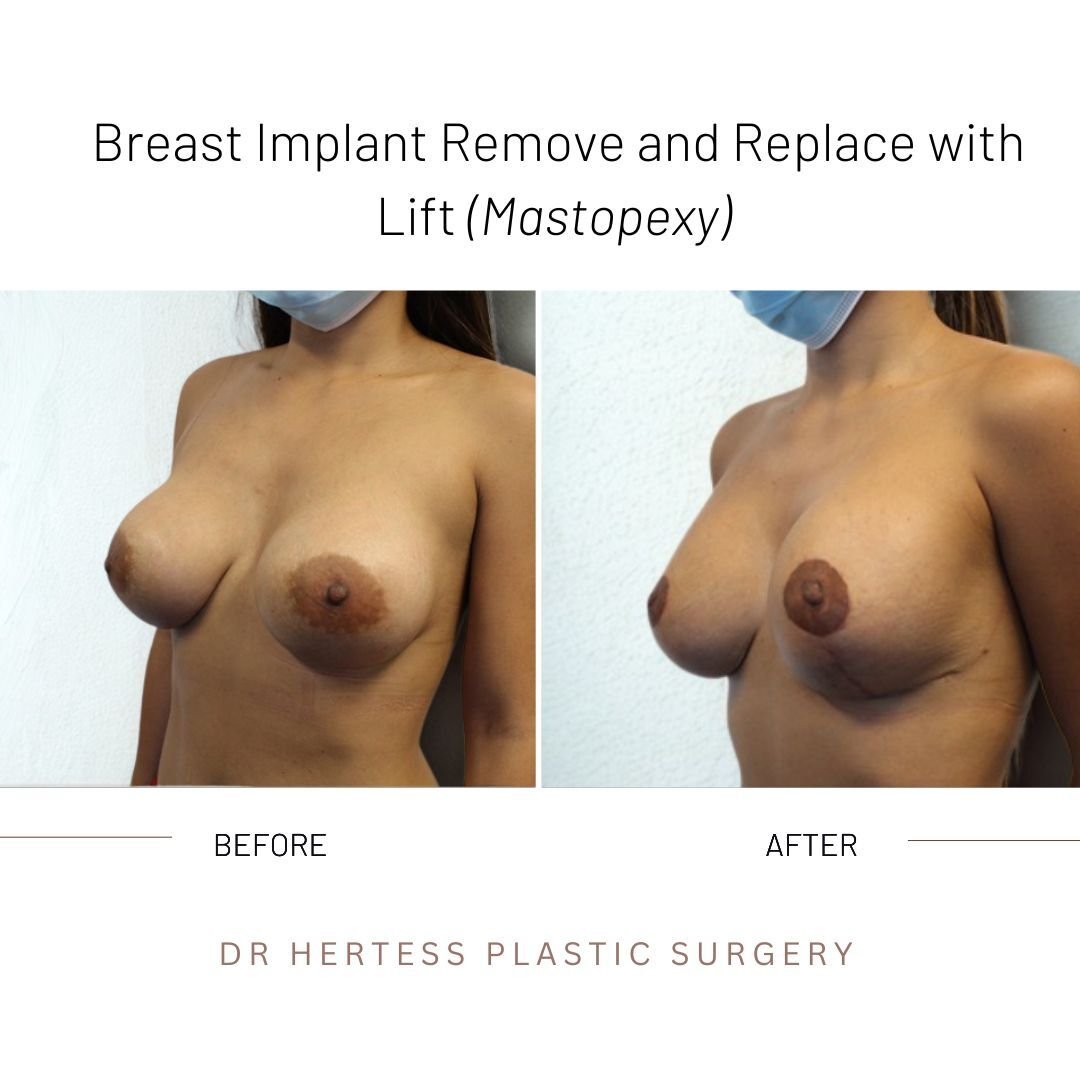 before and after breasts