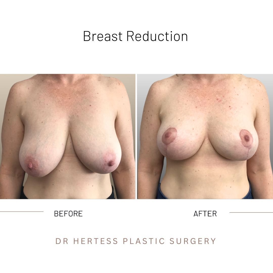 before and after breast reduction