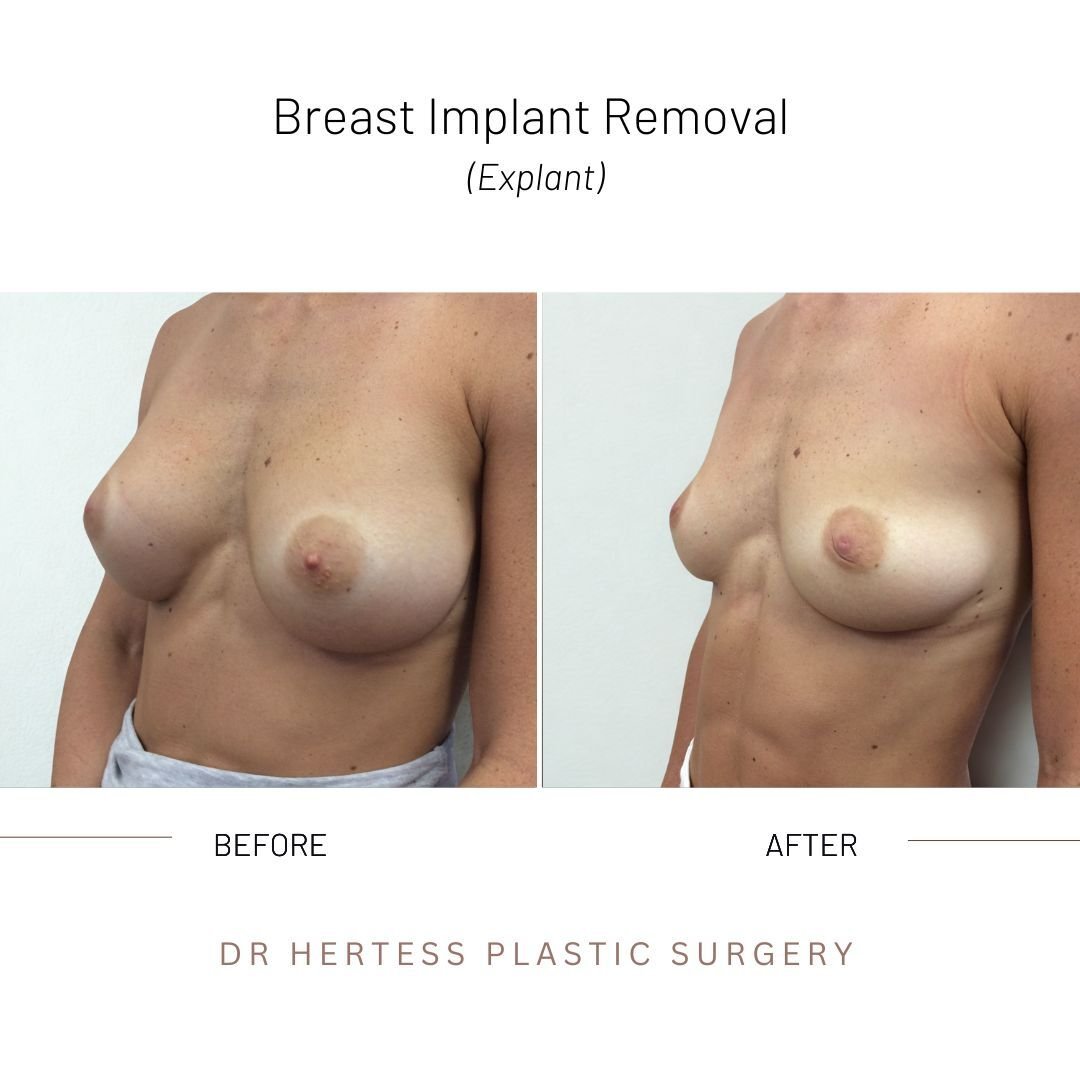 explant before and after