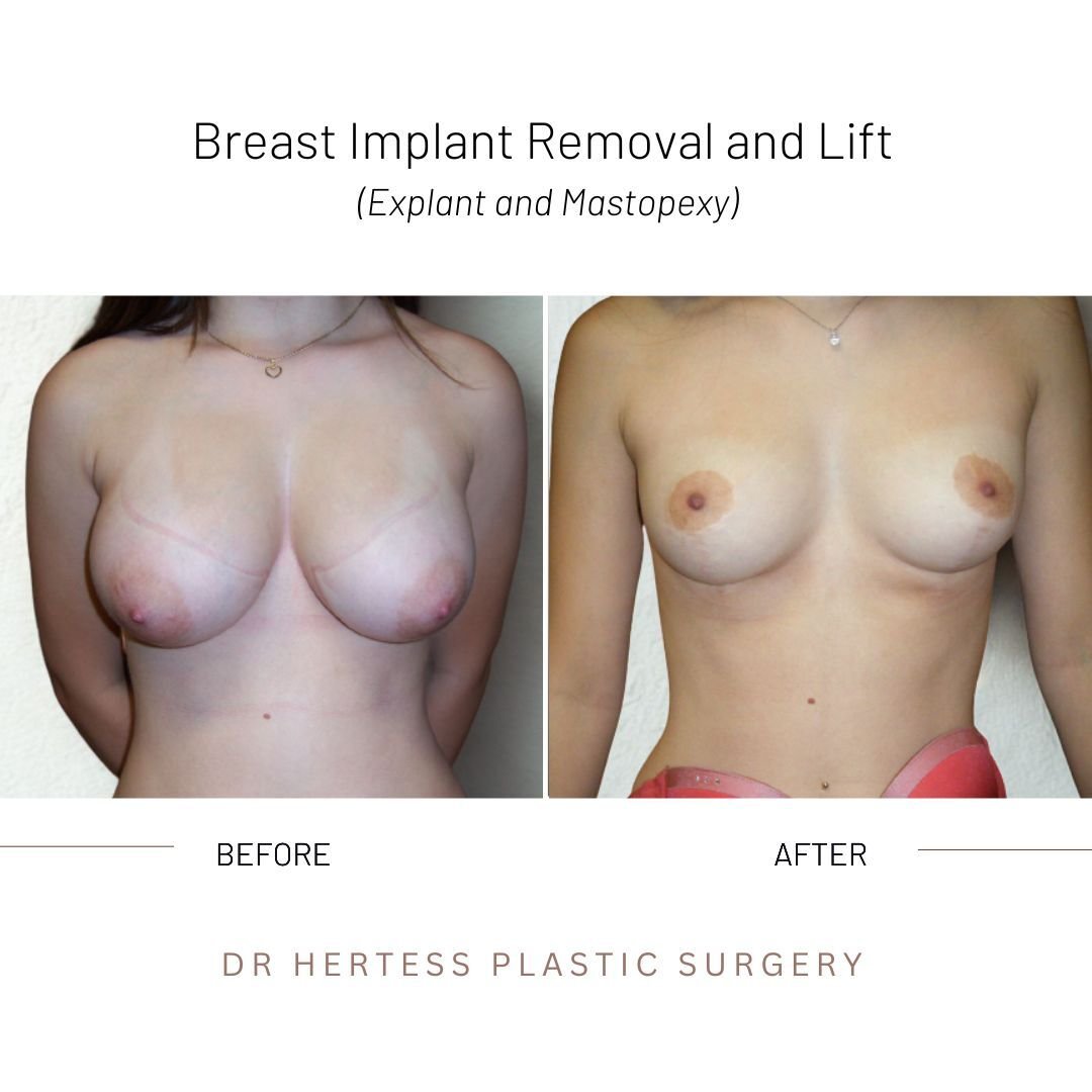 removal and lift before after