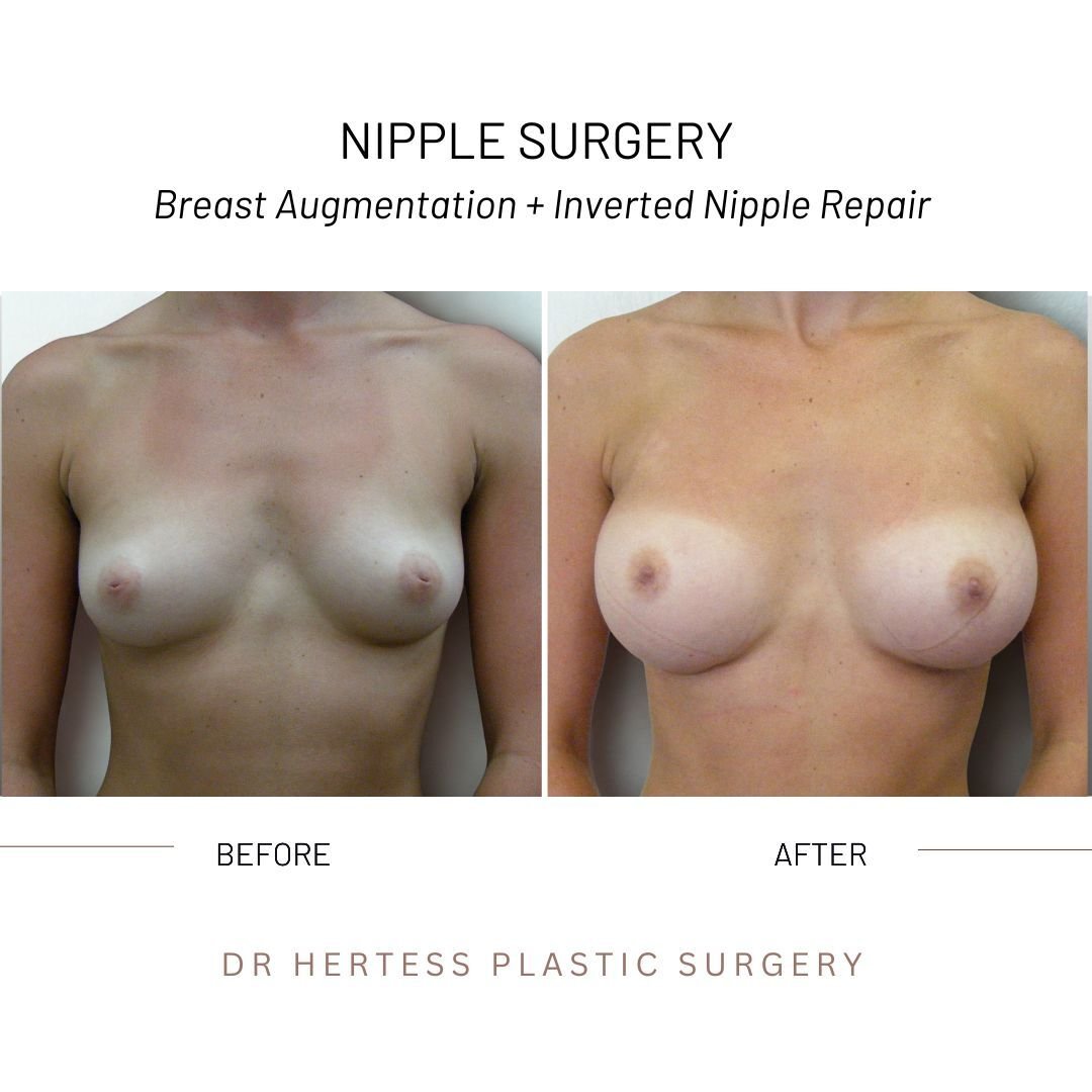 before and after nipple surgery