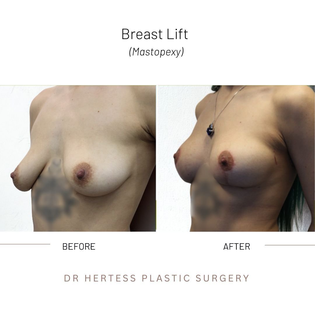 breast lift before and after