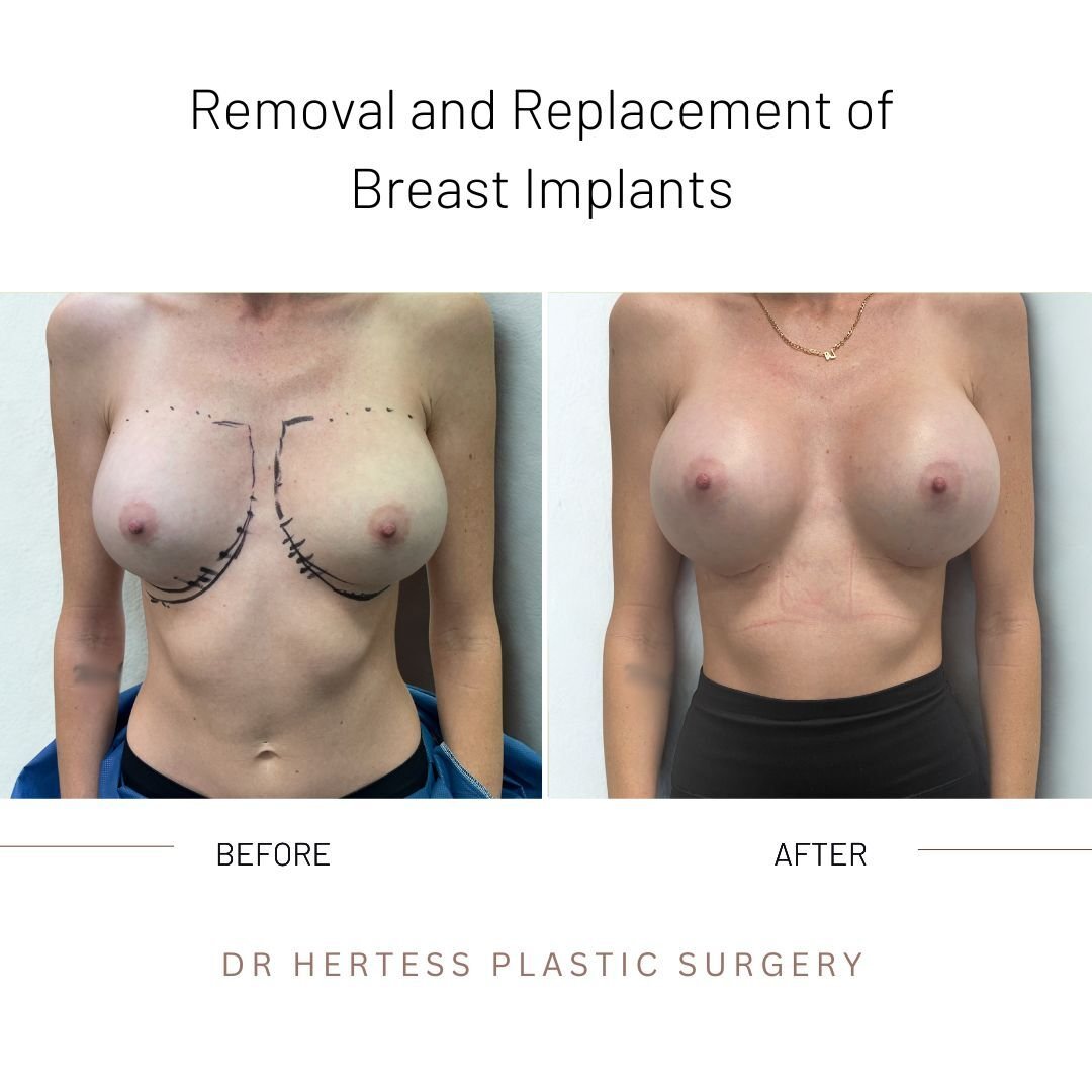 breast implant remove replace before and after