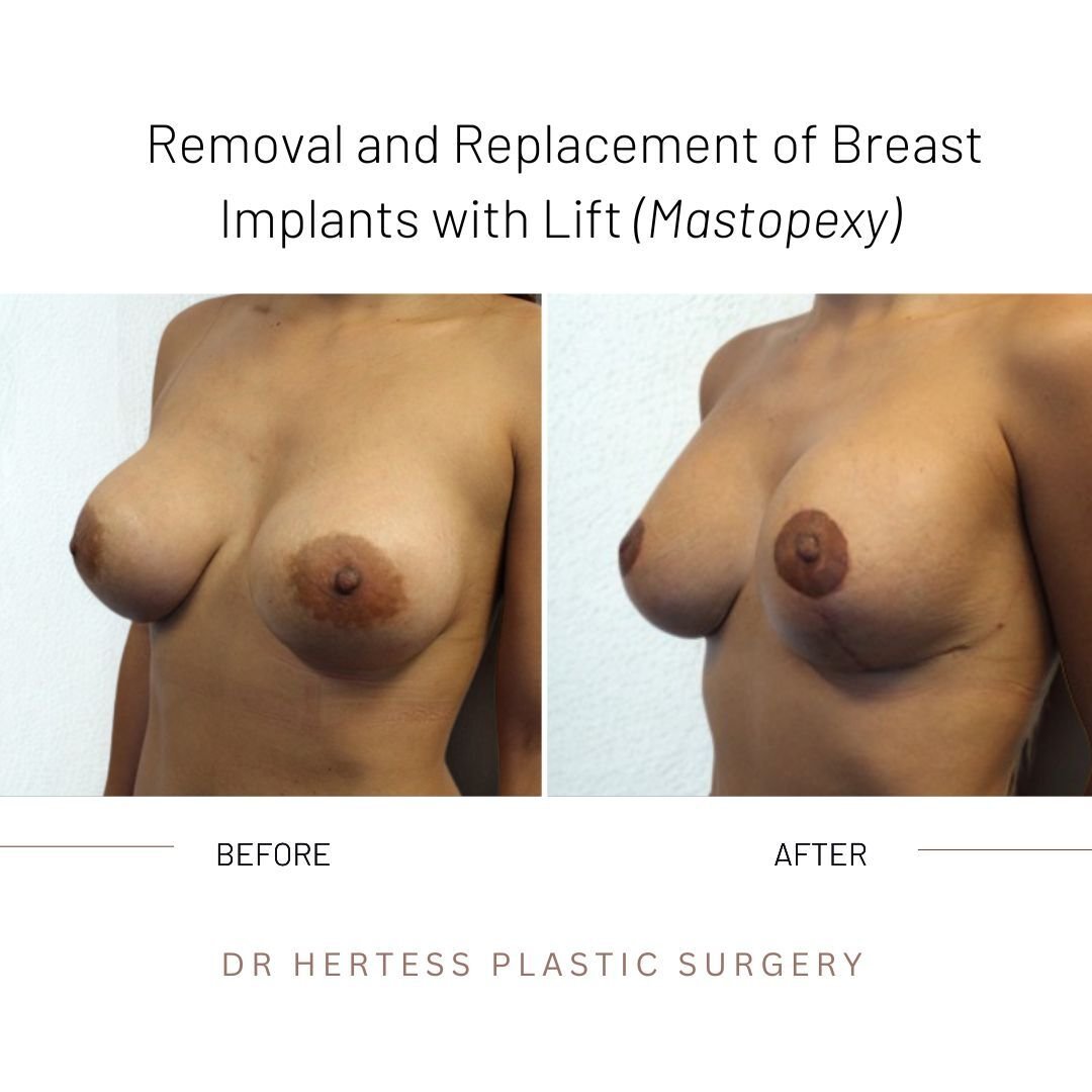 breast remove and replace before and after