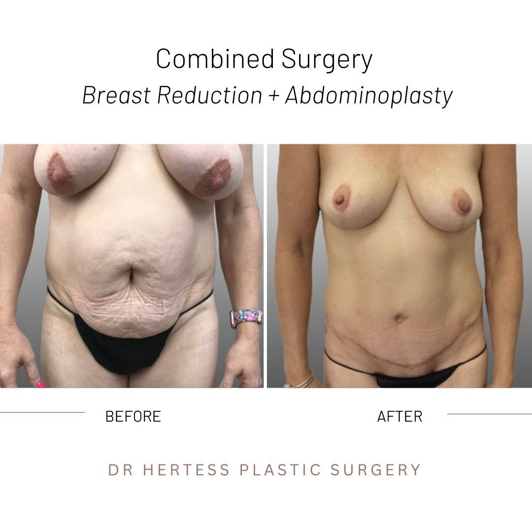 Mummy makeover before after