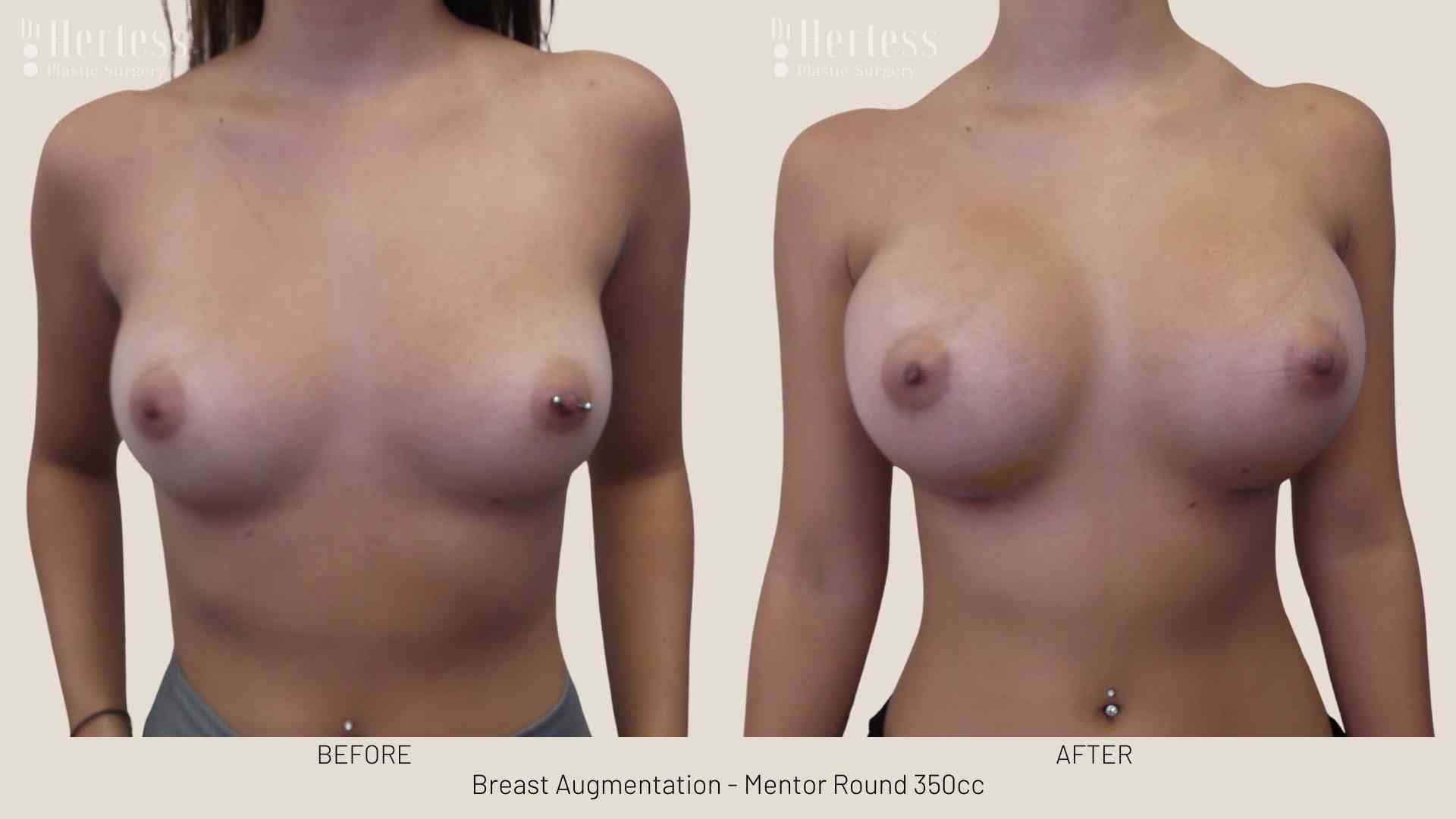 breast aug before and after