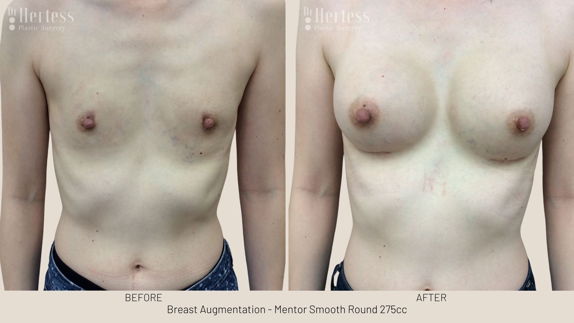 breast aug before and after