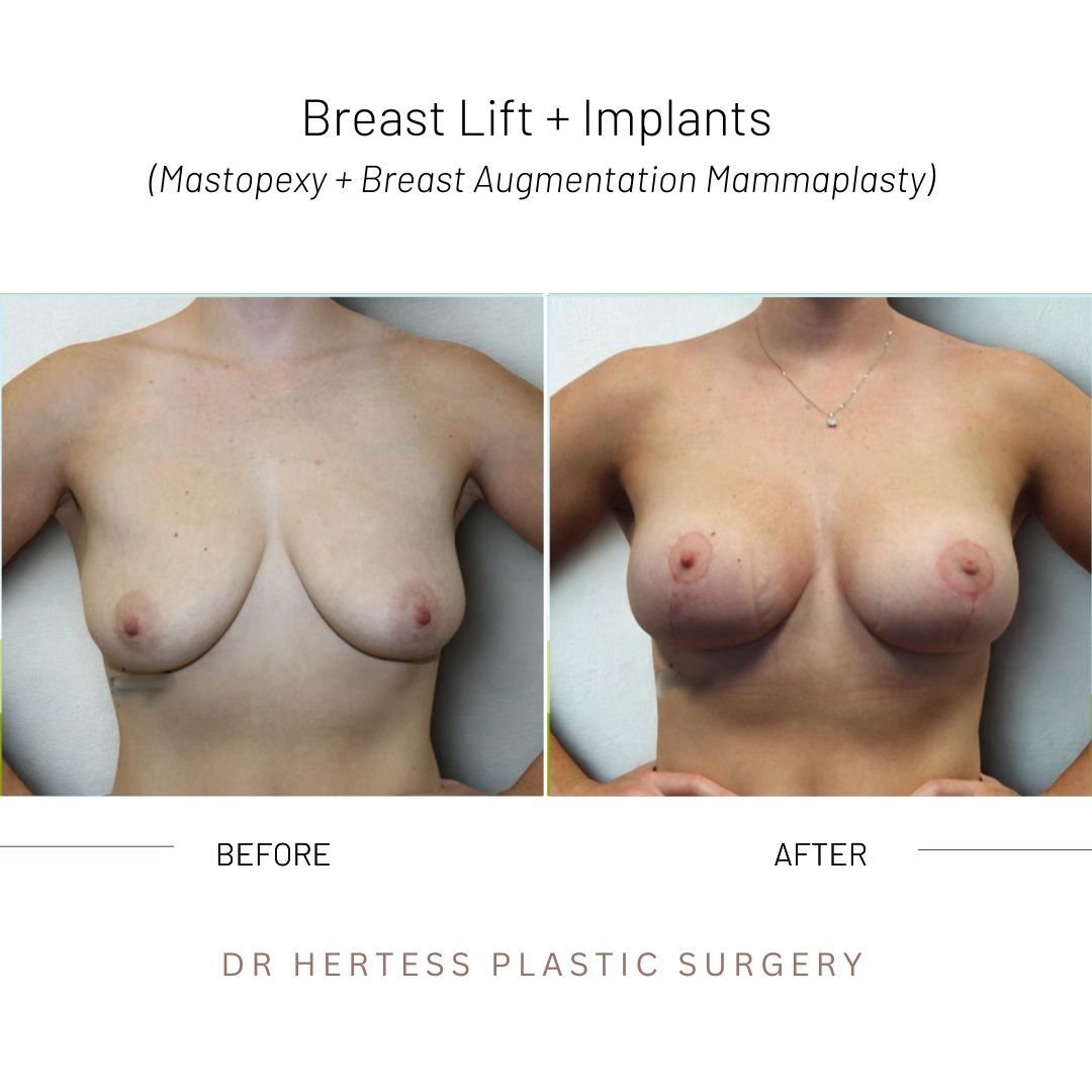 boob lift before and after
