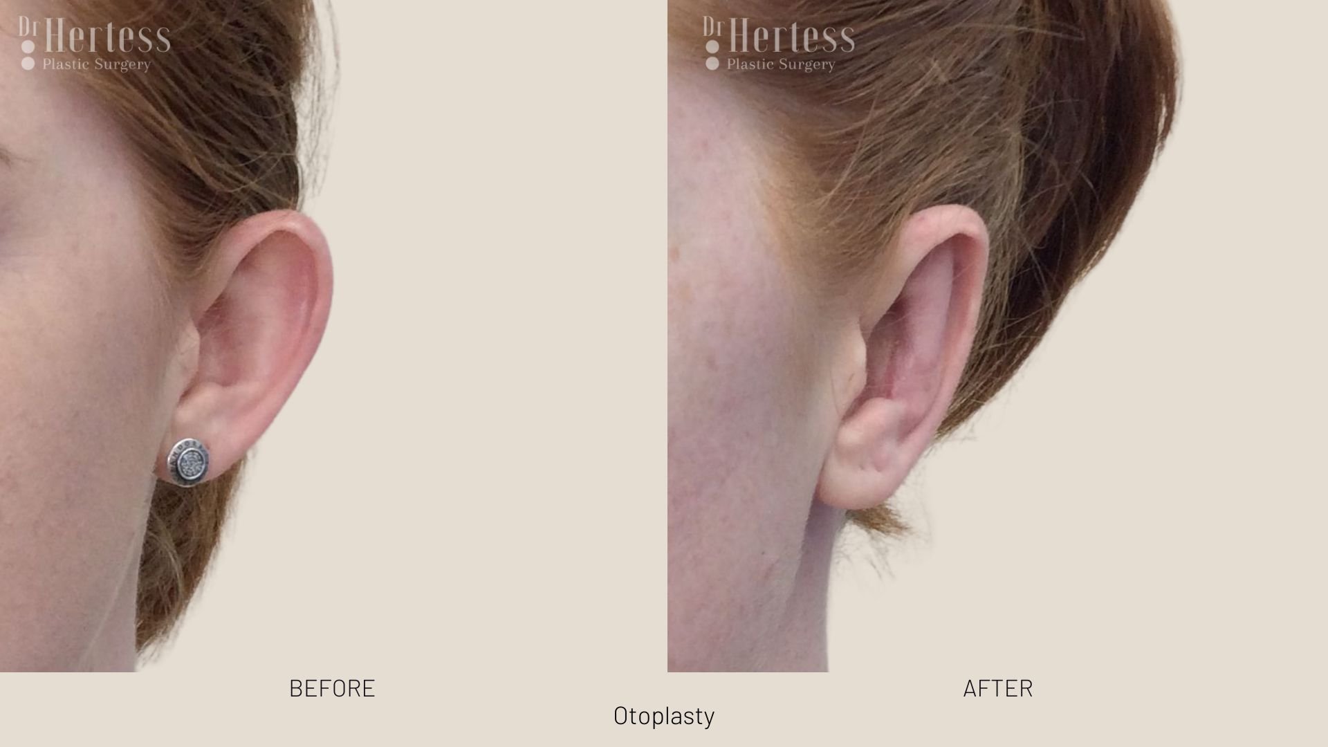 otoplasty before and after