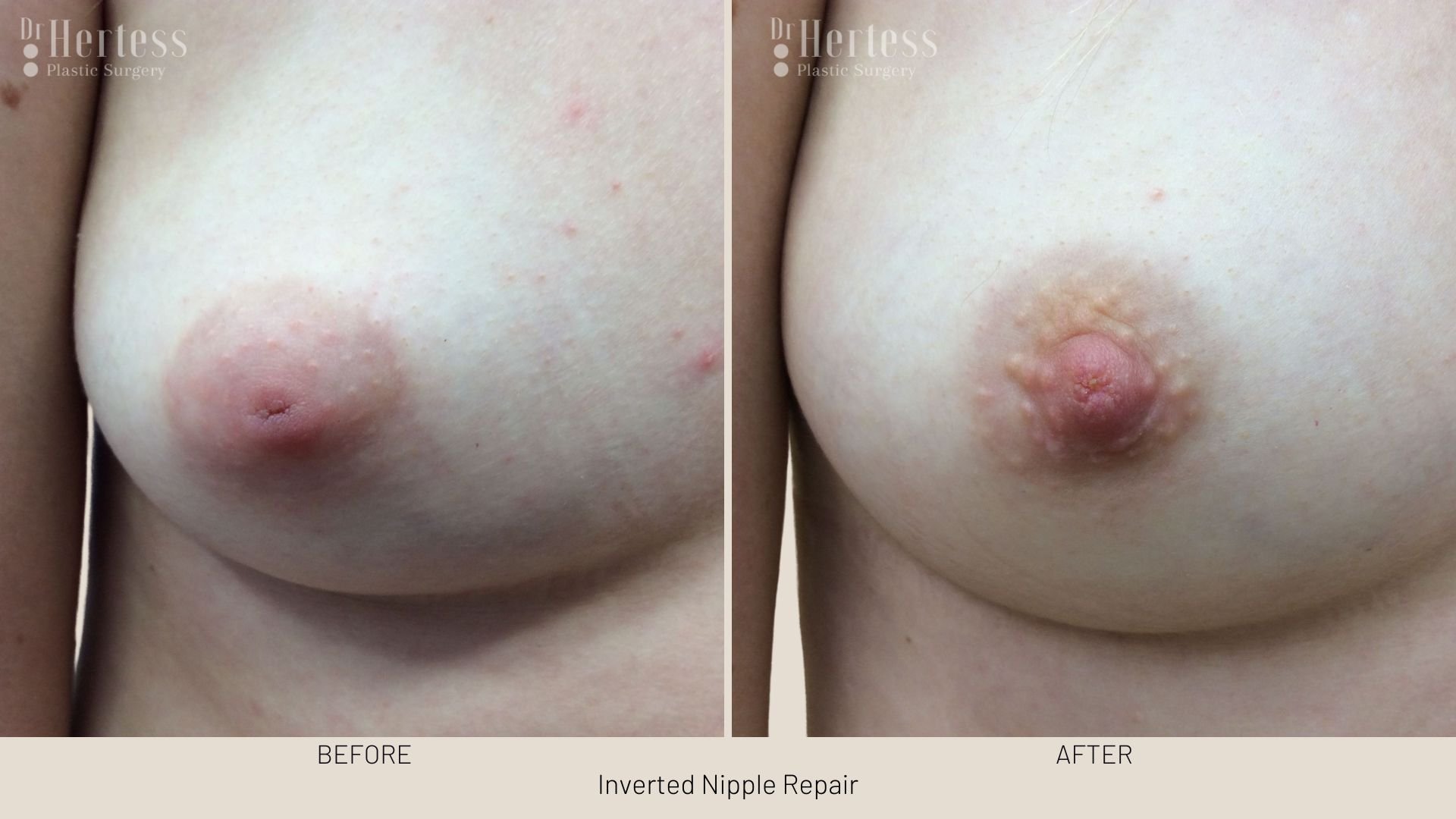 surgery for inverted nipple