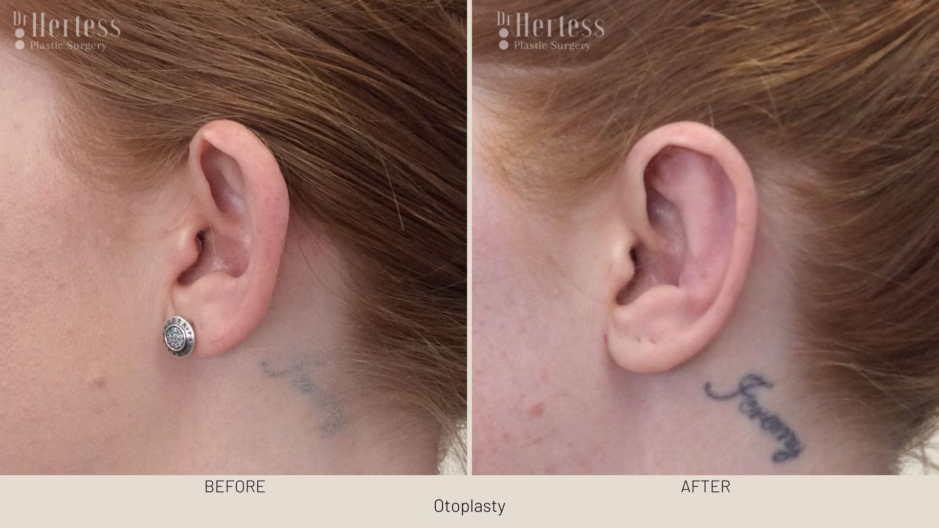 otoplasty before and after