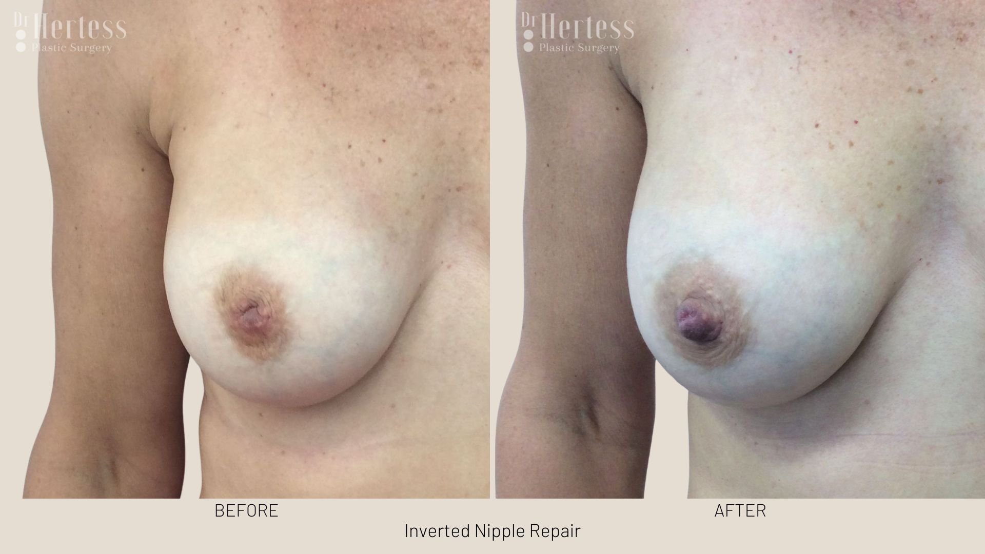 surgery for inverted nipple