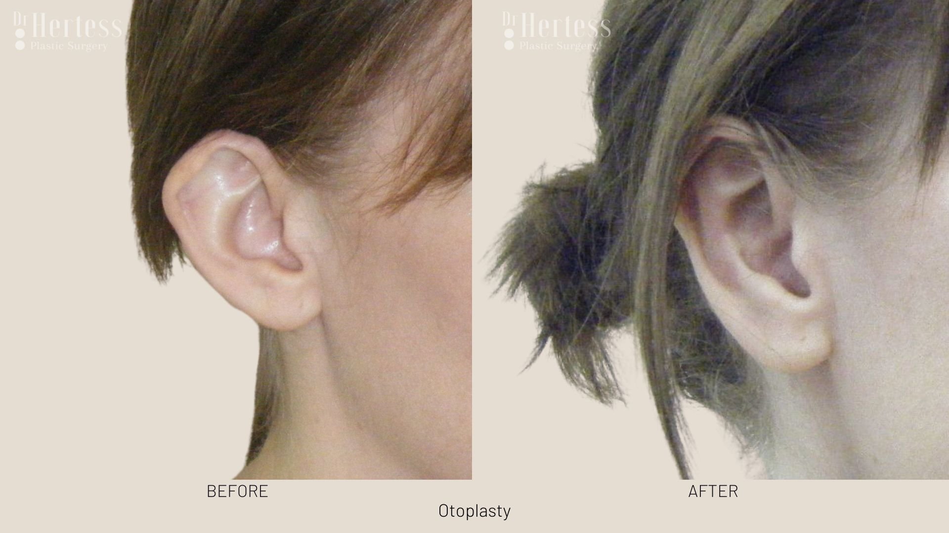 otoplasty before and after