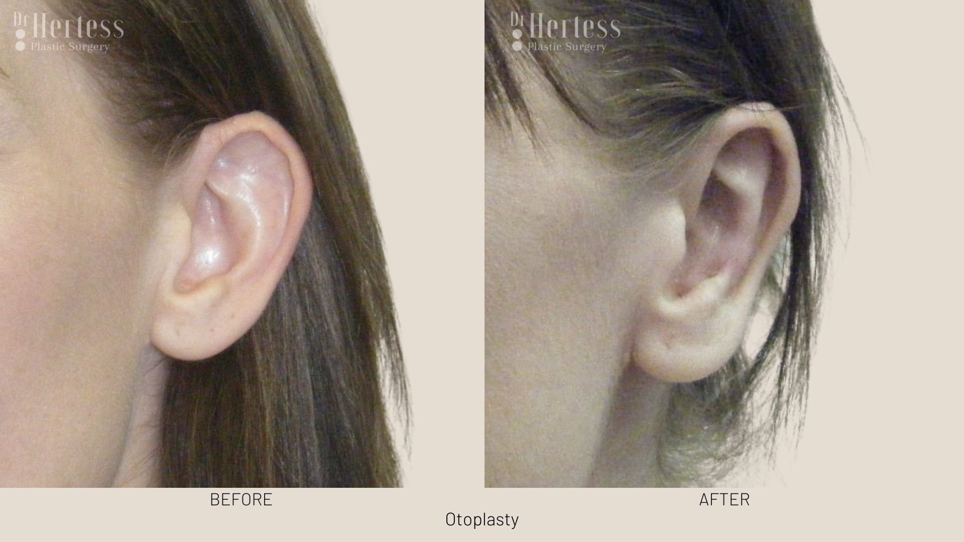 otoplasty before and after