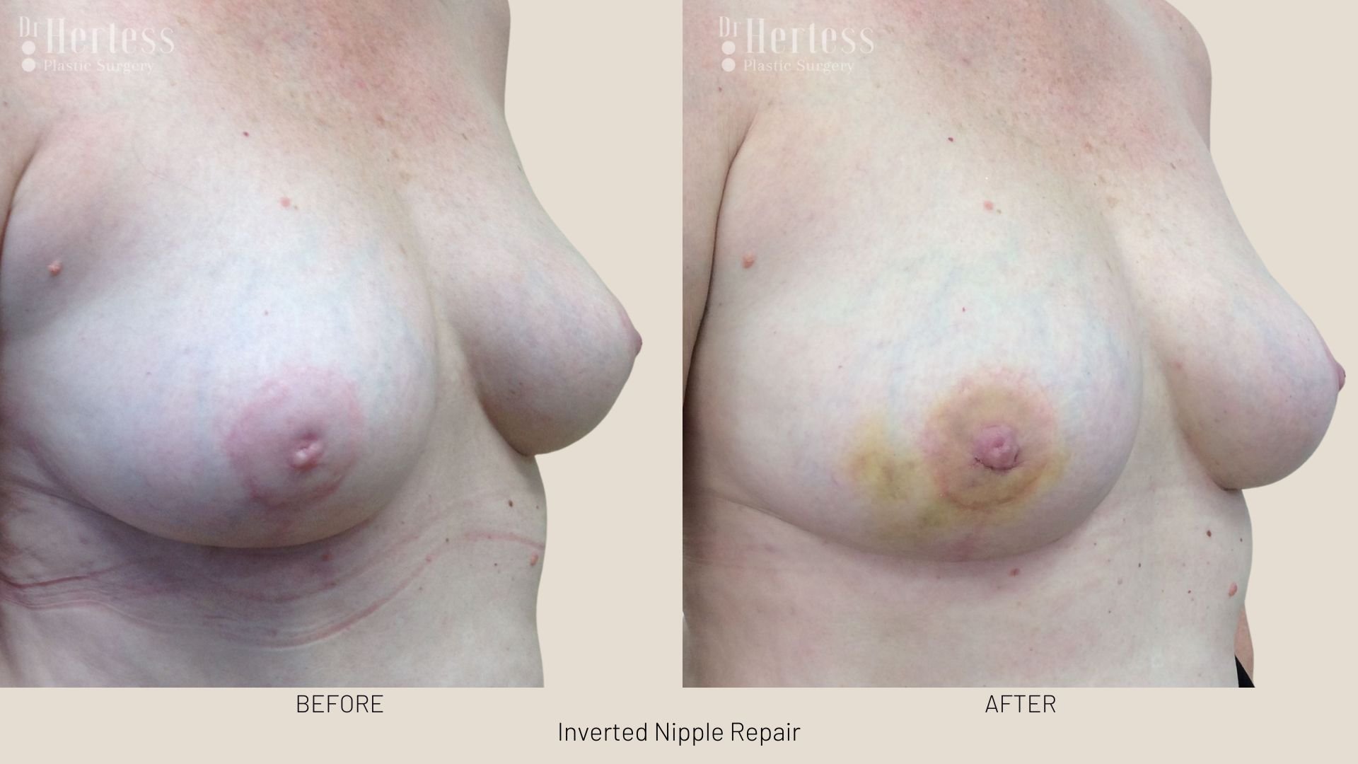 surgery for inverted nipple