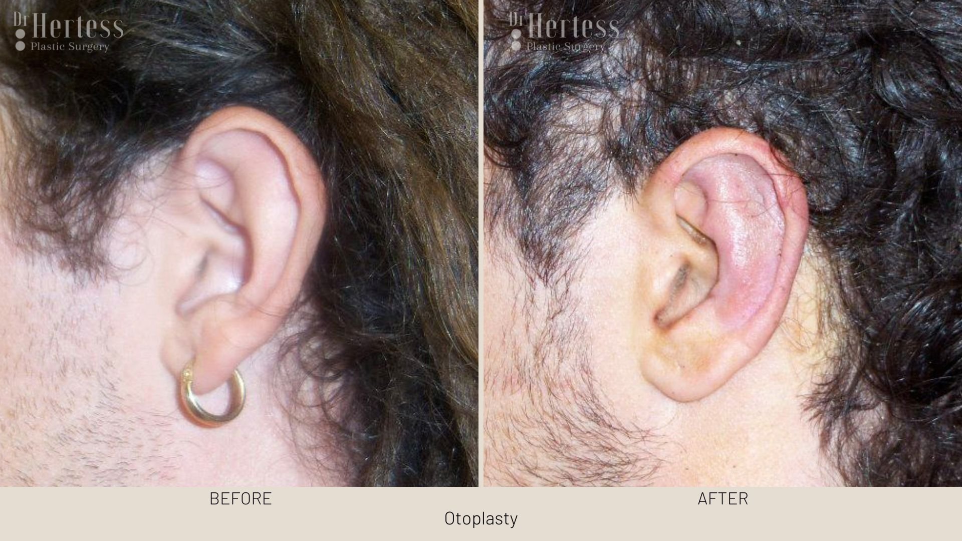 ear pinning before and after