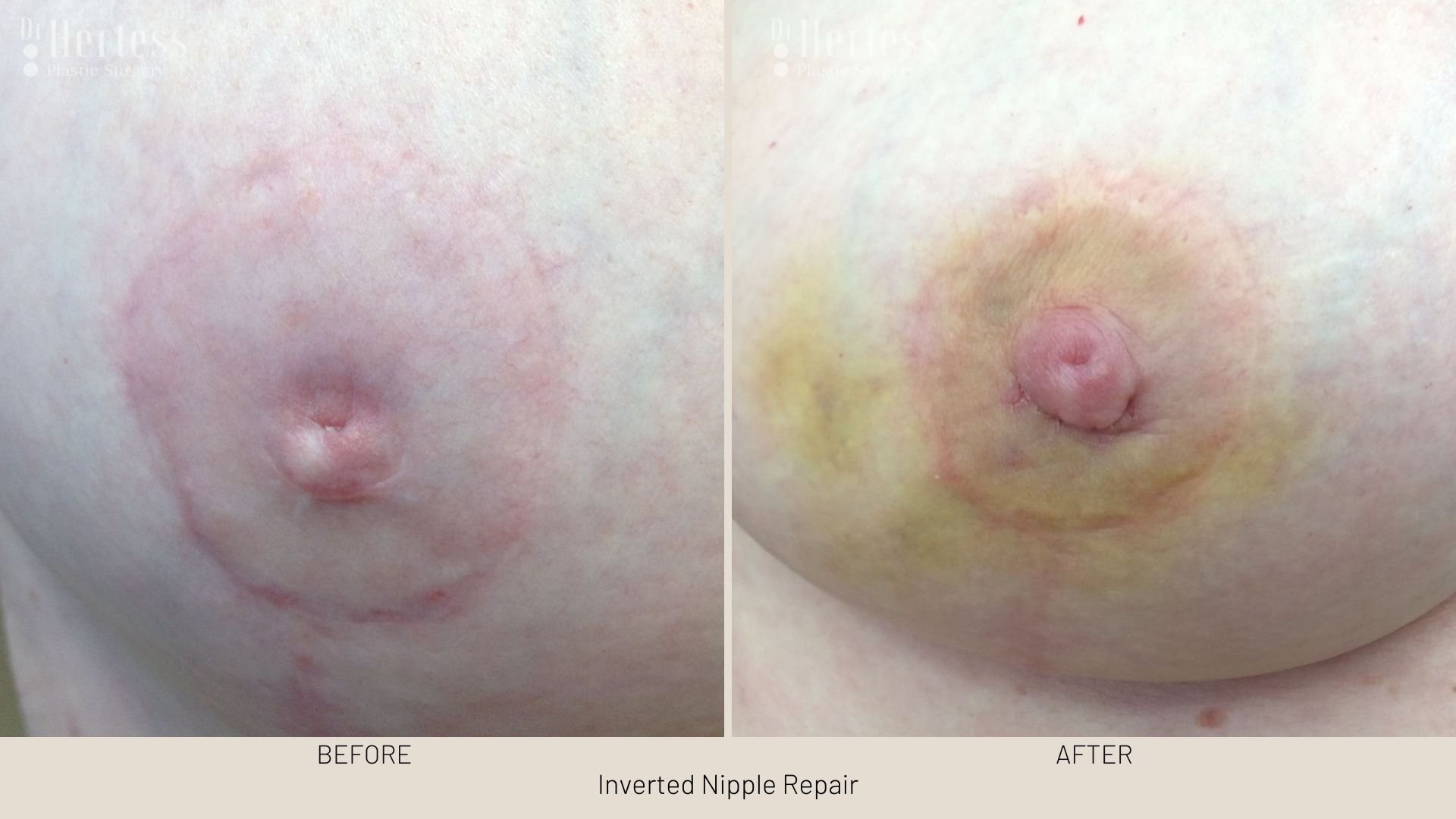 surgery for inverted nipple