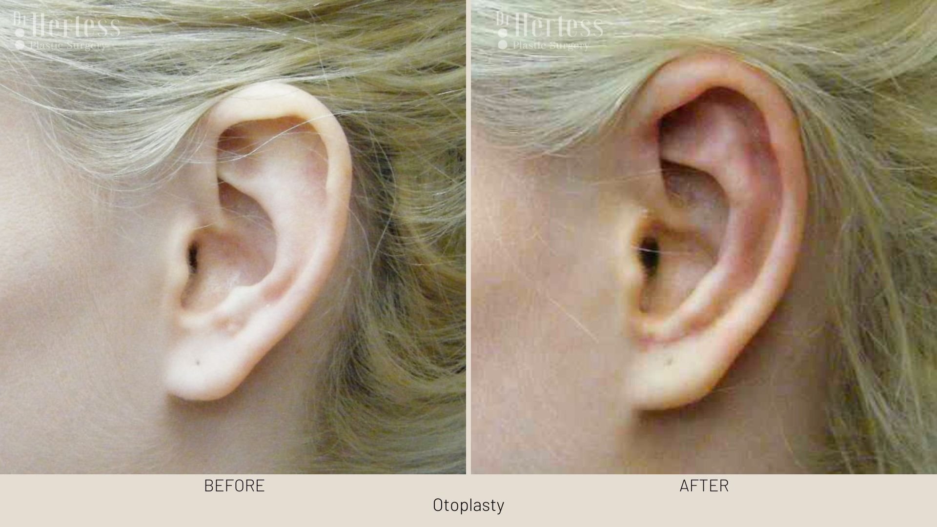 ear pinning before and after