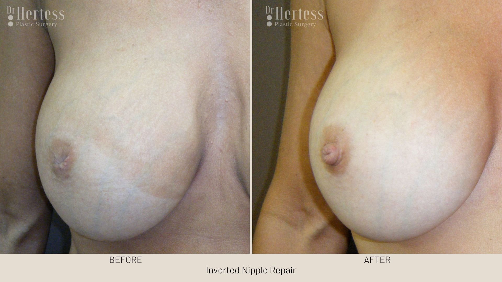 surgery for inverted nipple