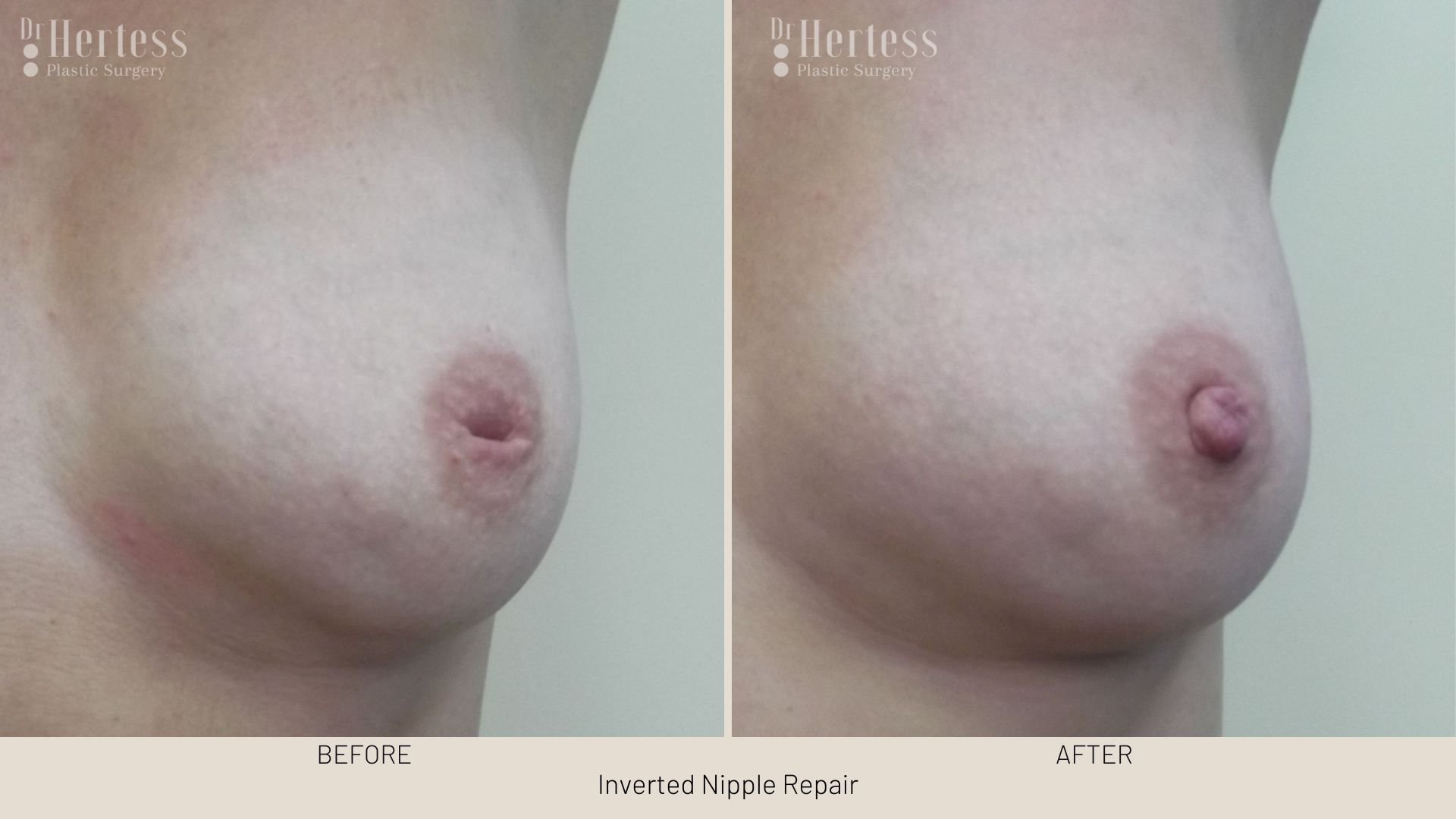 surgery for inverted nipple