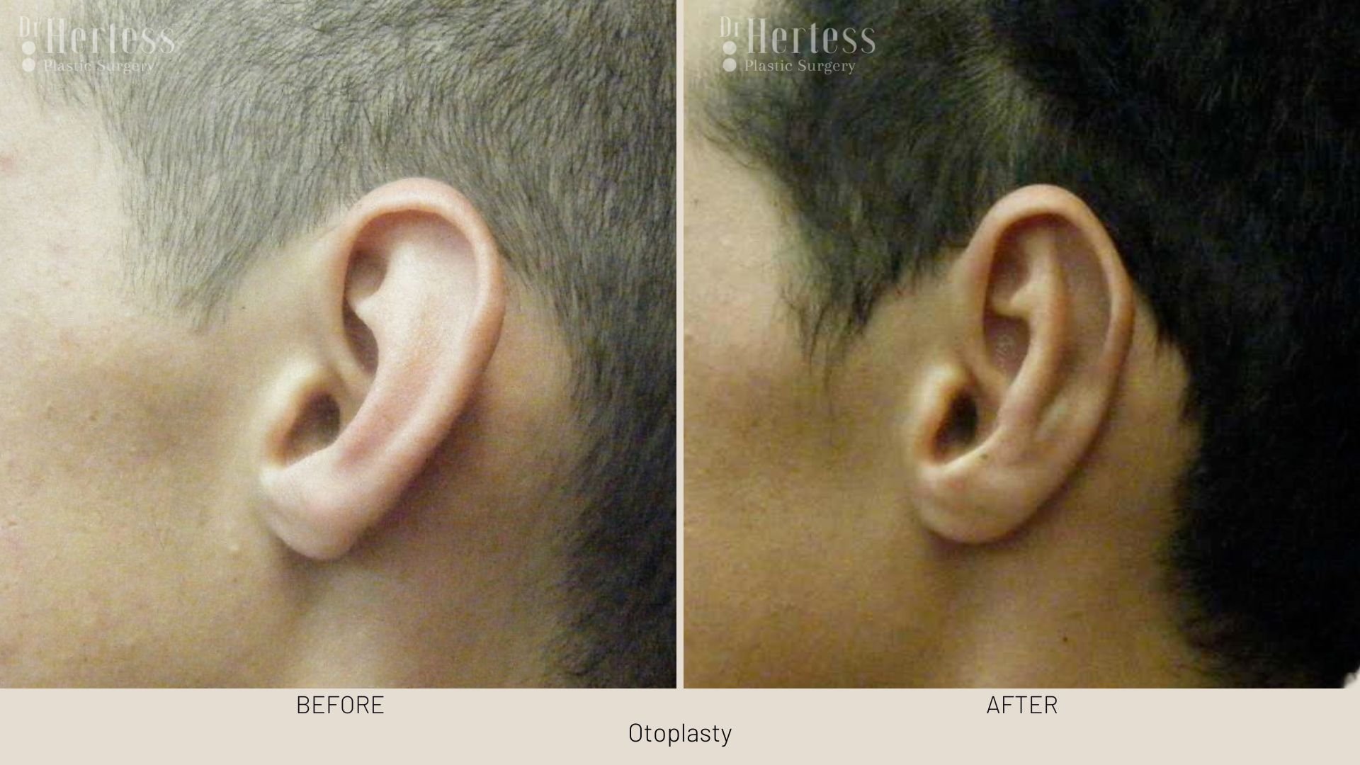 ear pinning before and after