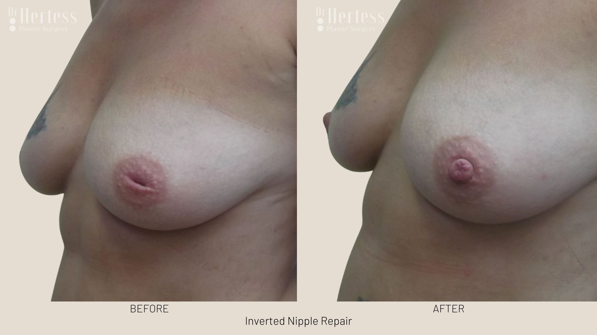 surgery for inverted nipple