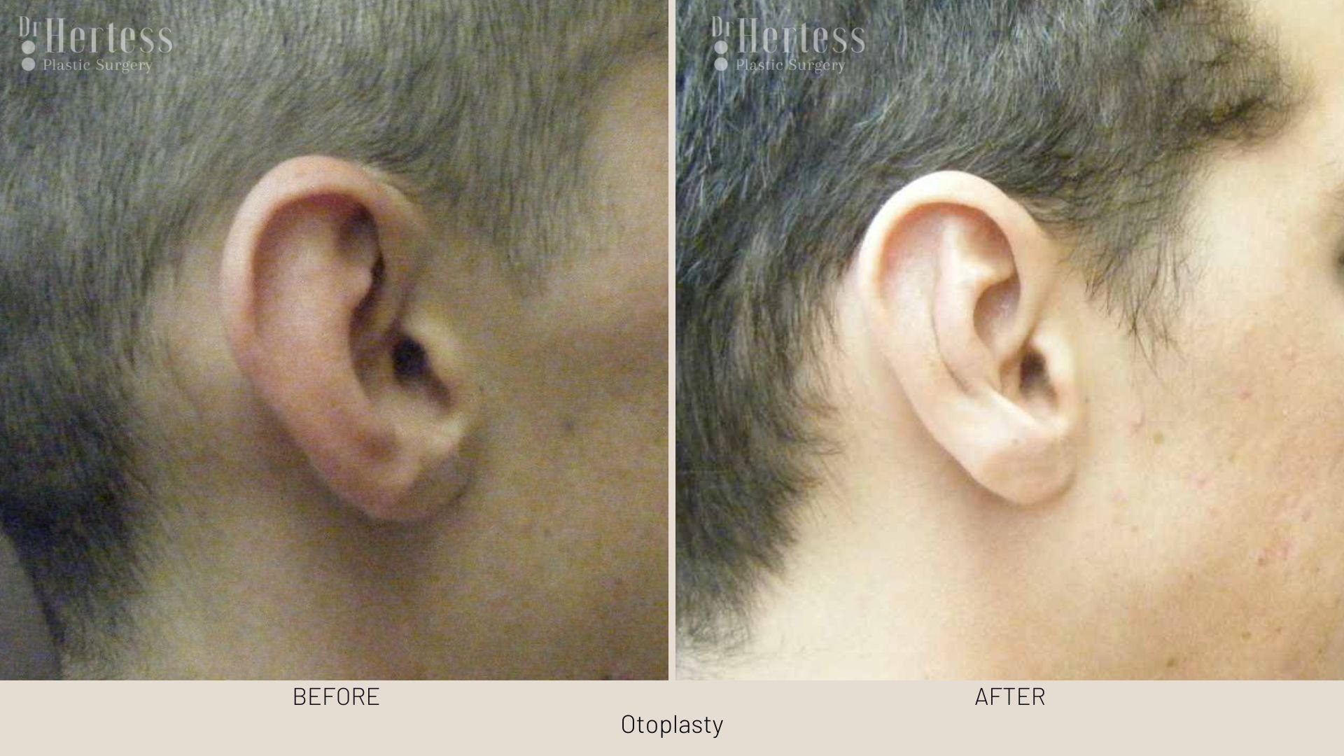 ear pinning before and after