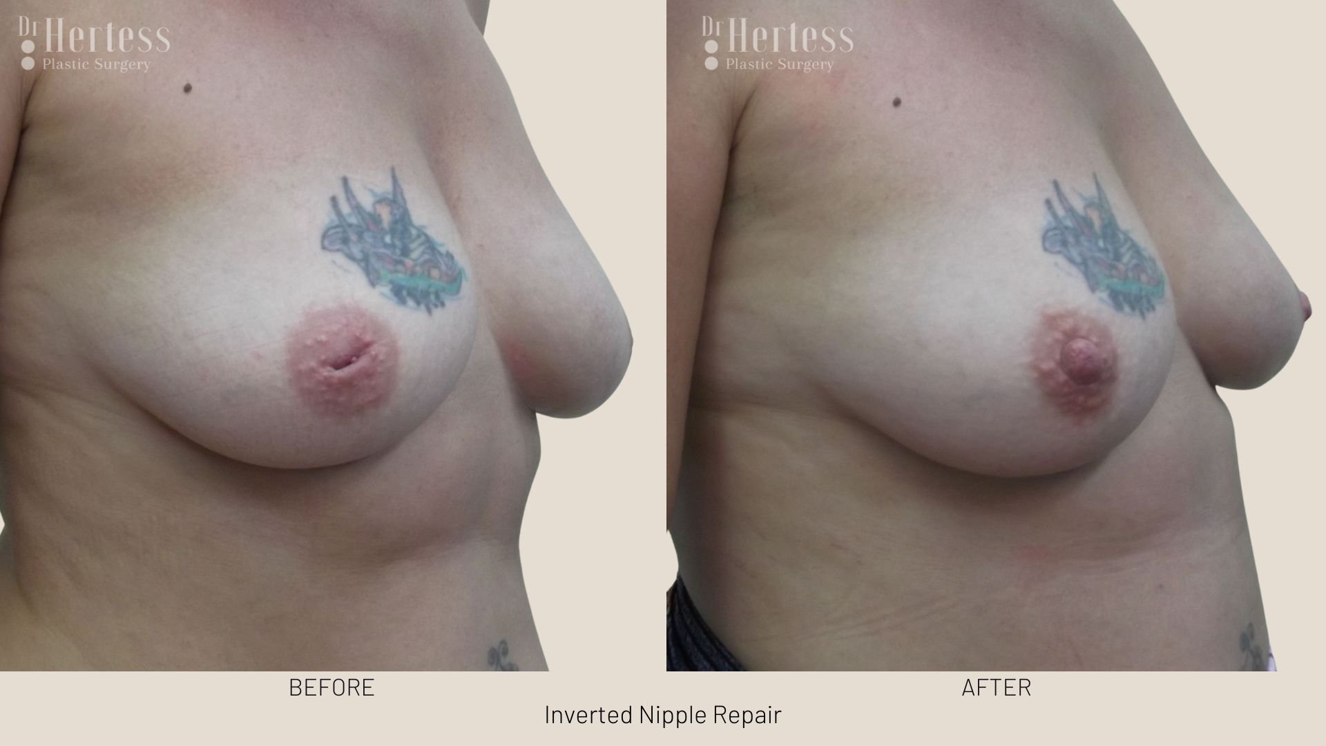 surgery for inverted nipple