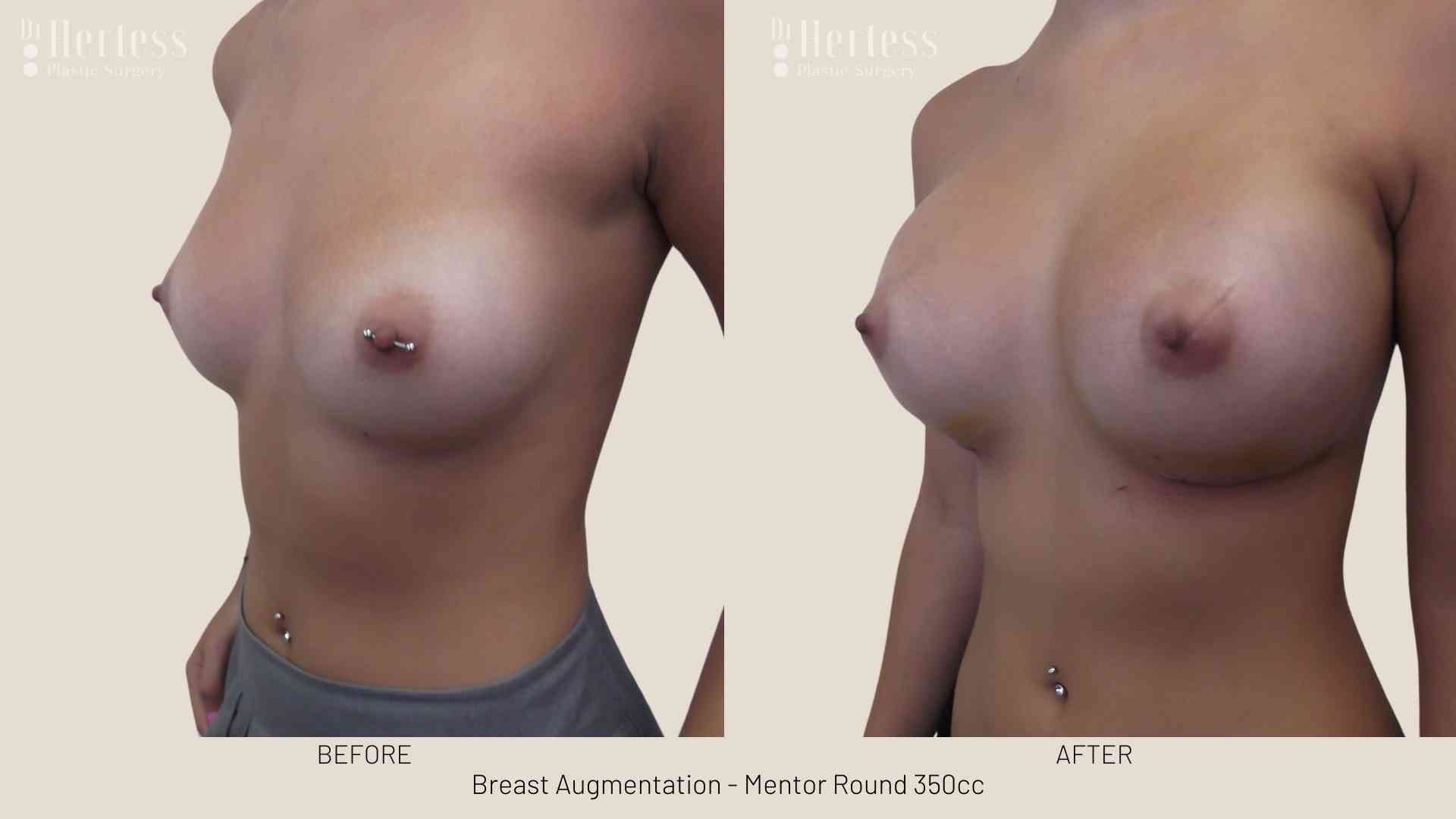 breast aug before and after