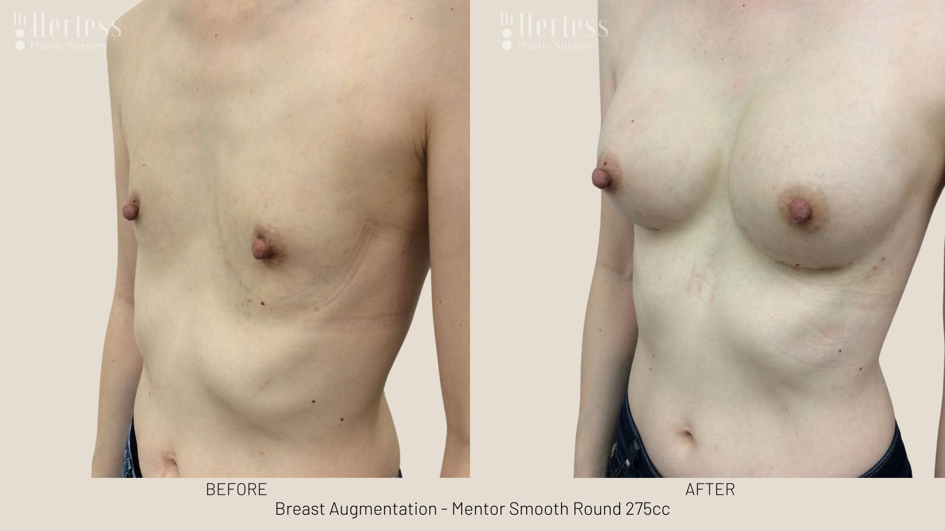 breast aug before and after