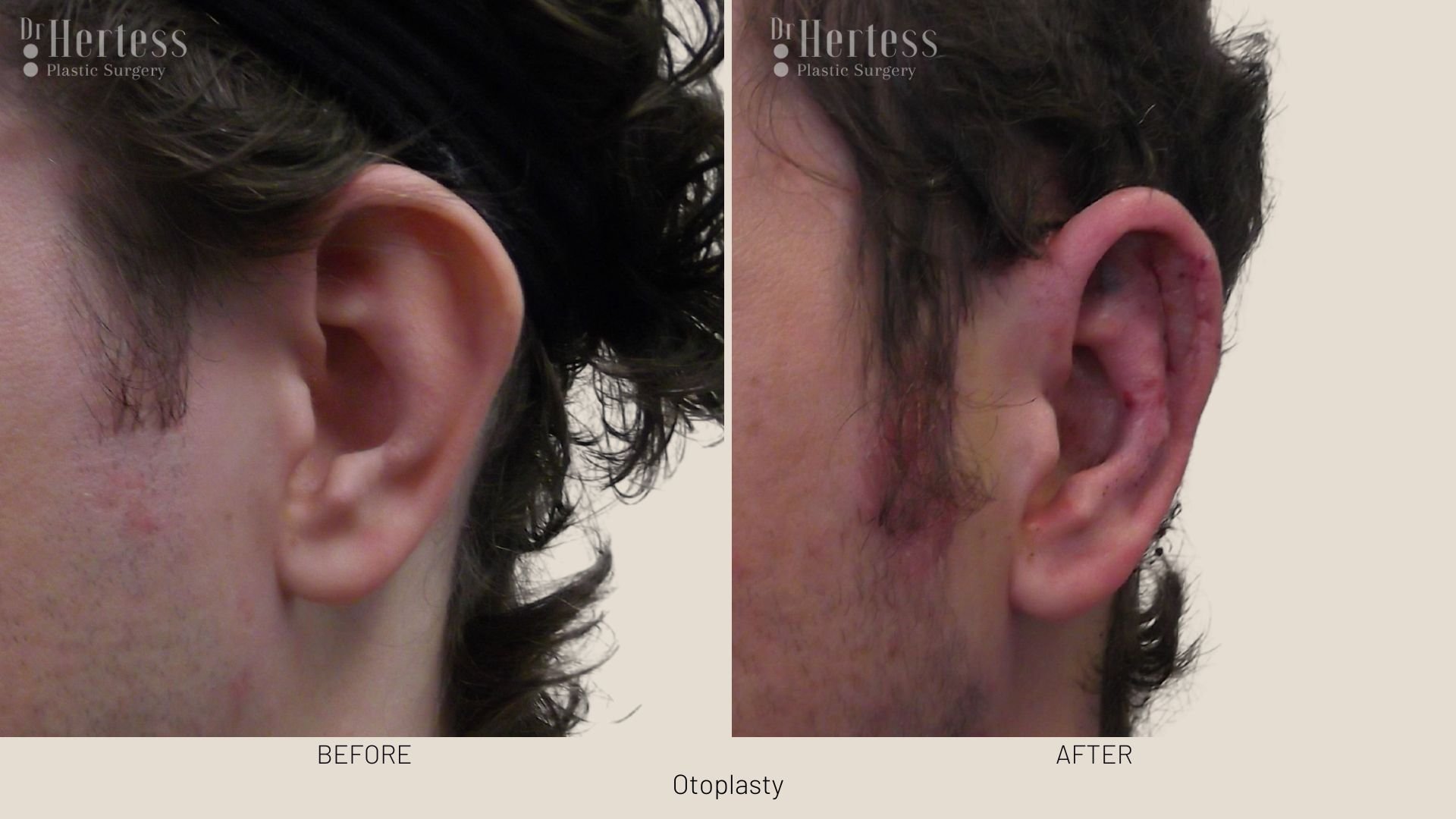 ear pinning before and after