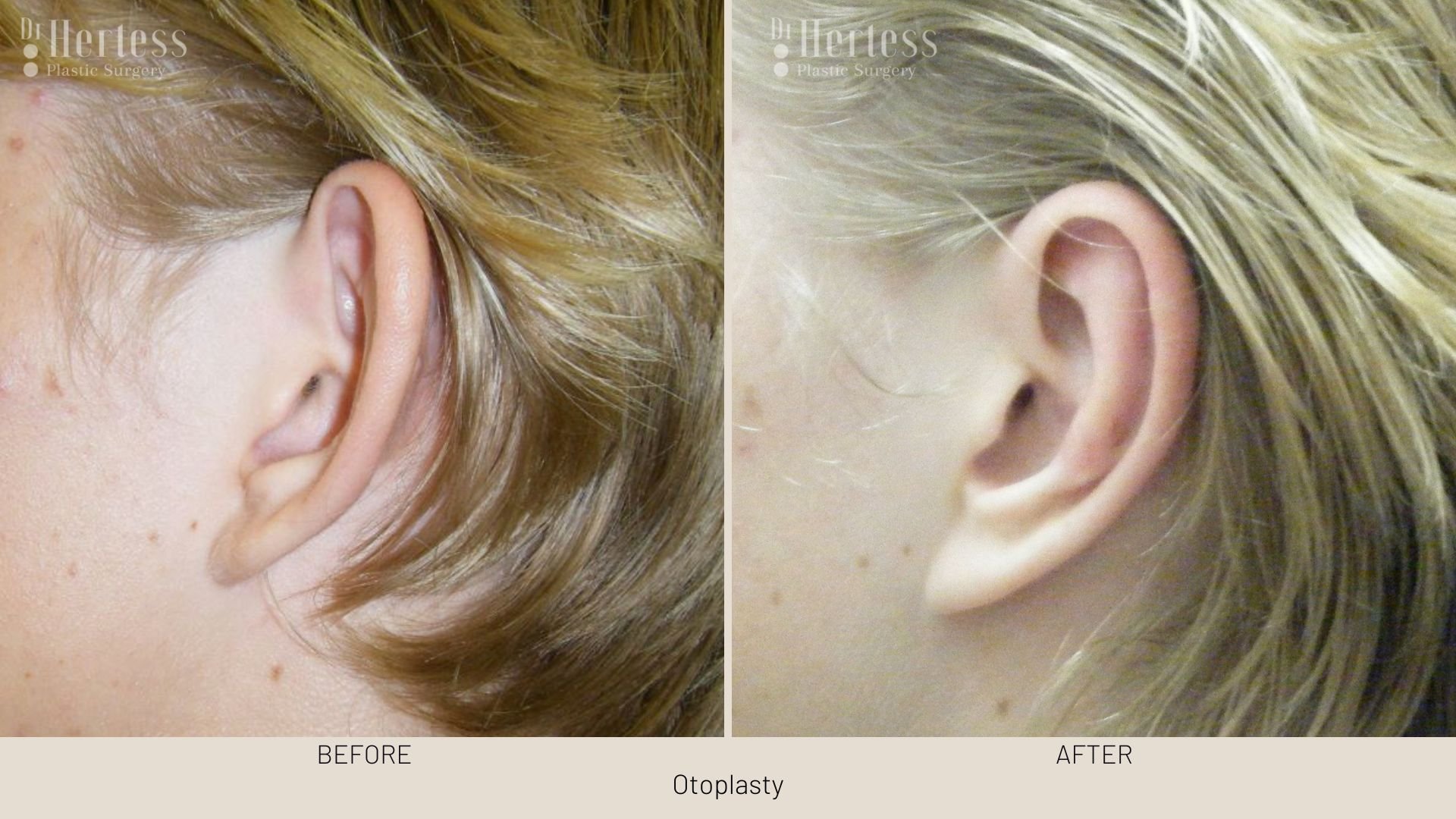 ear pinning before and after