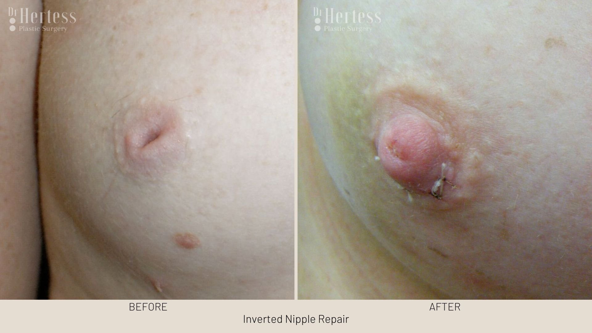 surgery for inverted nipple