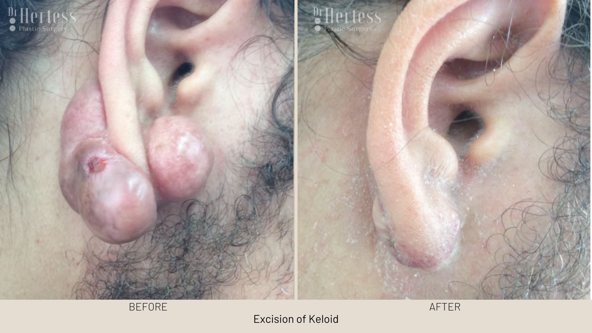 keloid scar removal