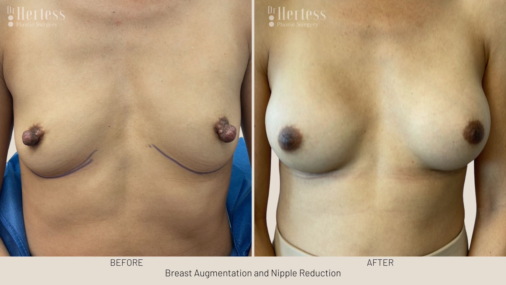 nipple surgery reduction