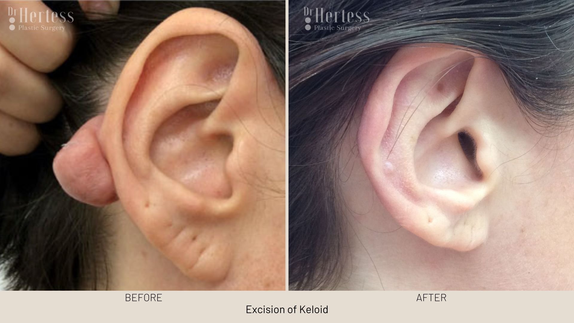 keloid scar removal