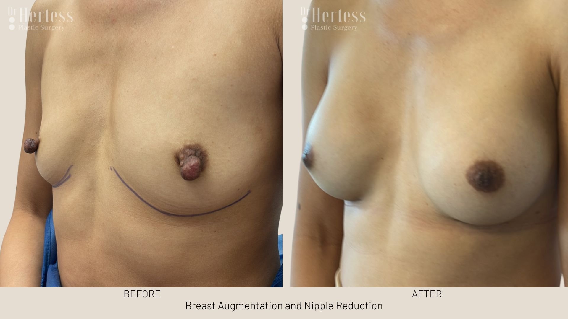 nipple surgery reduction