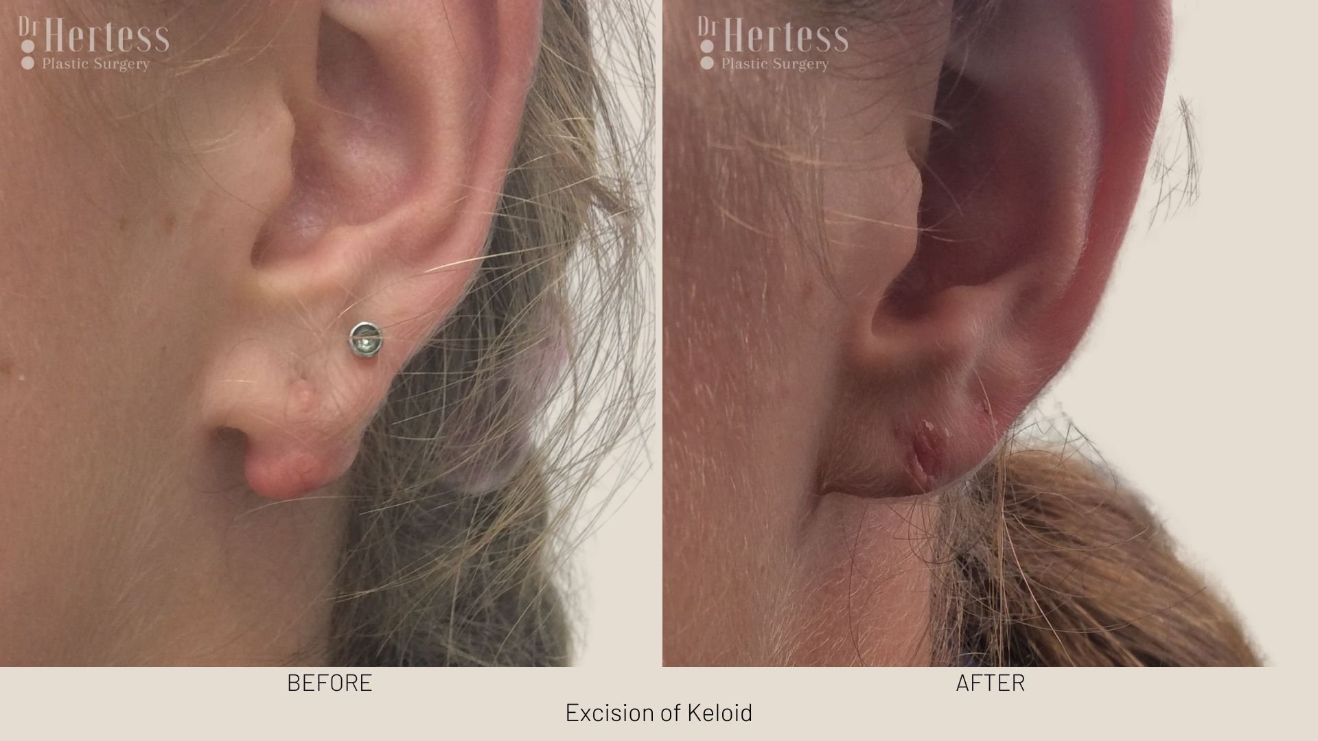 keloid scar removal