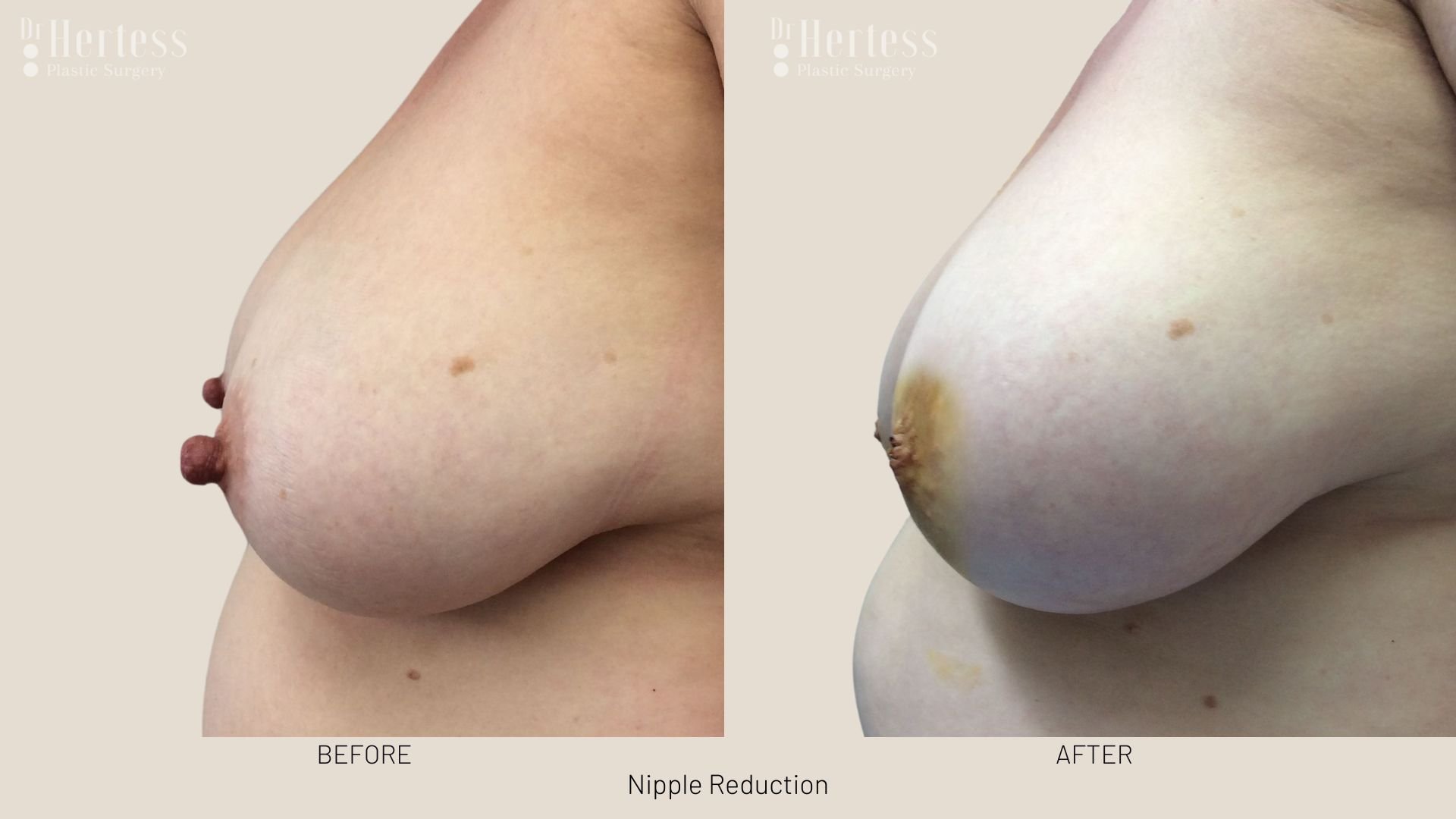 nipple surgery reduction