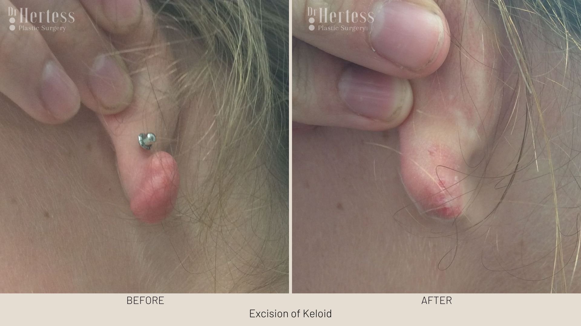 keloid scar removal