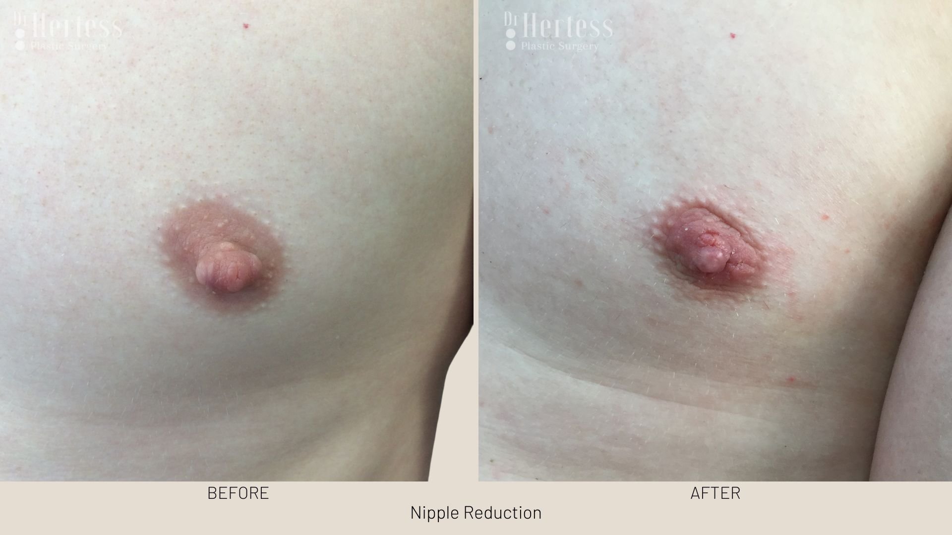 nipple surgery reduction