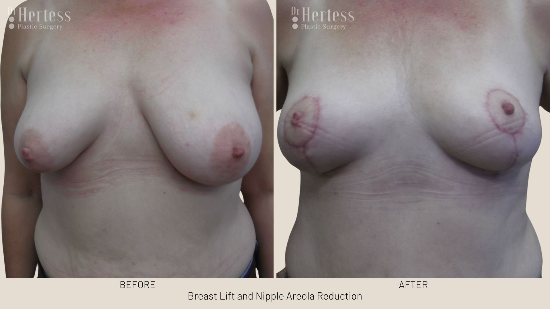 areola reduction