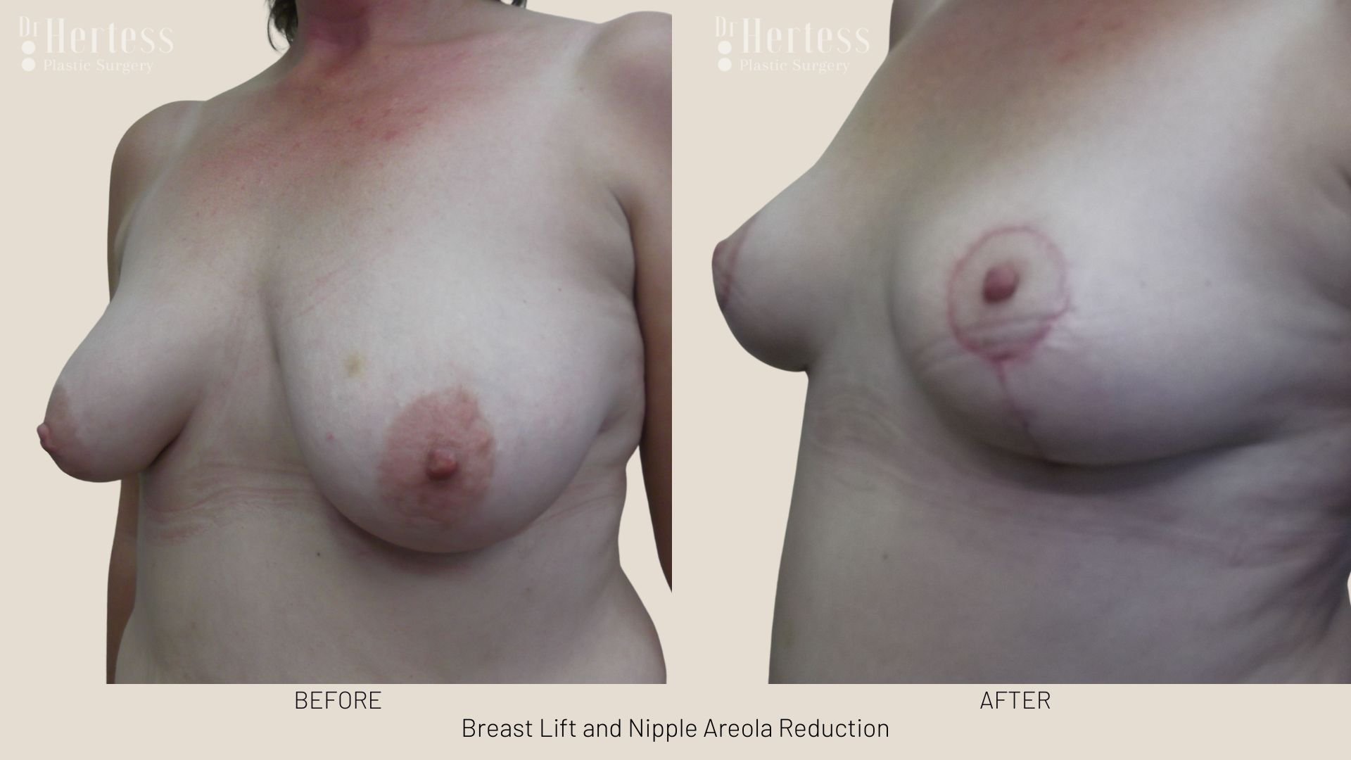 areola reduction