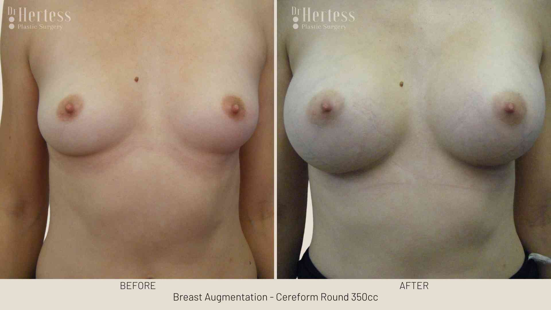 breast aug before and after