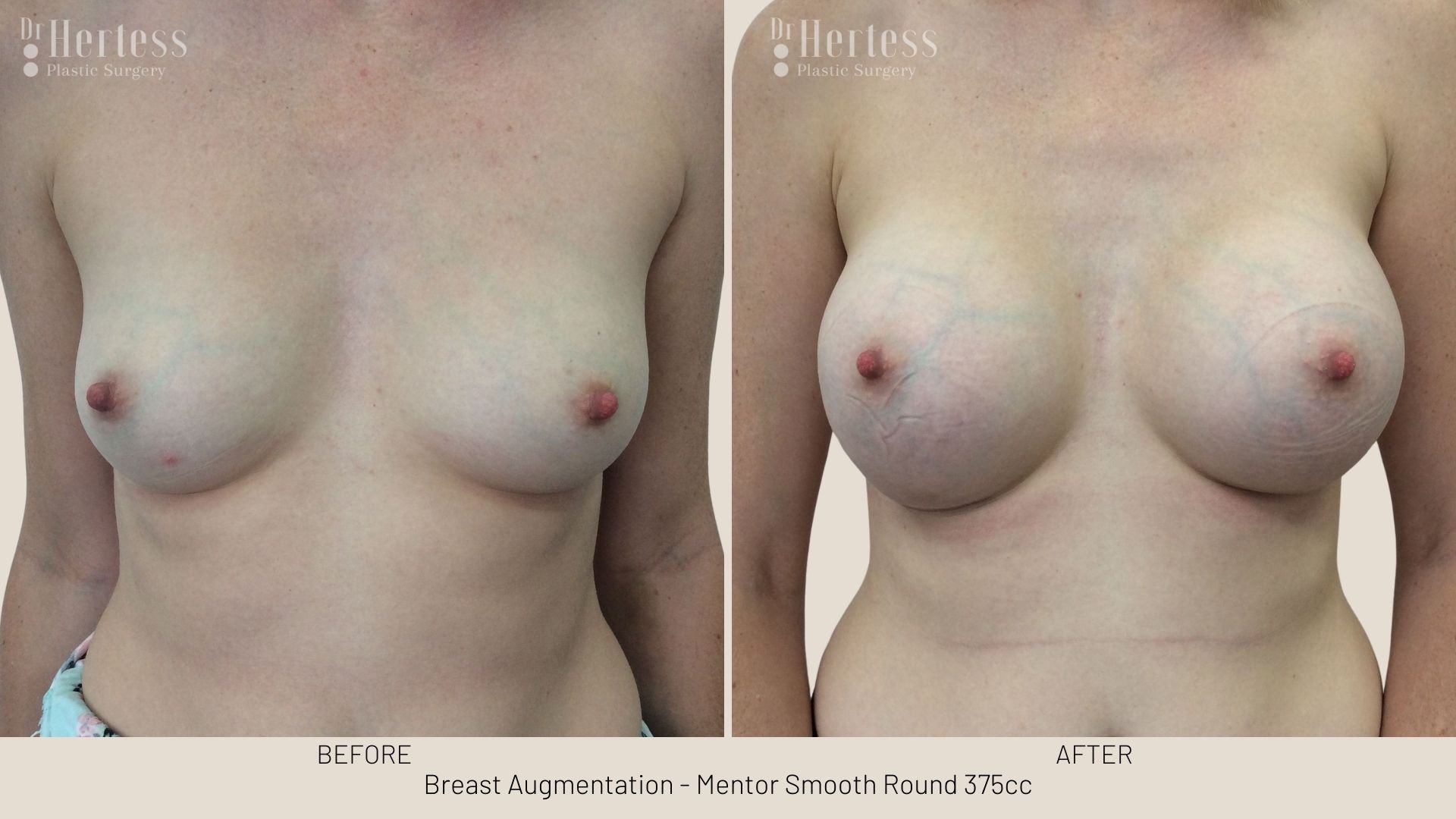 breast aug before and after