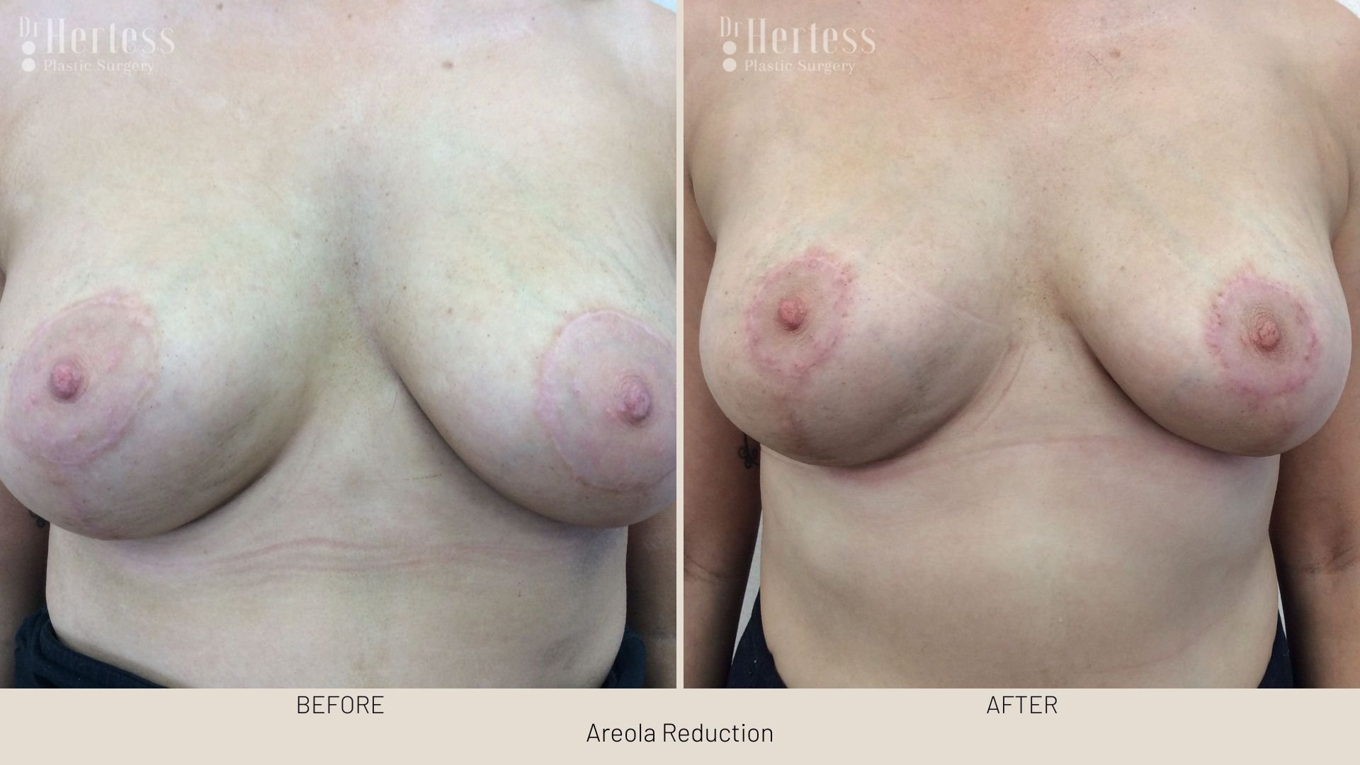 areola reduction