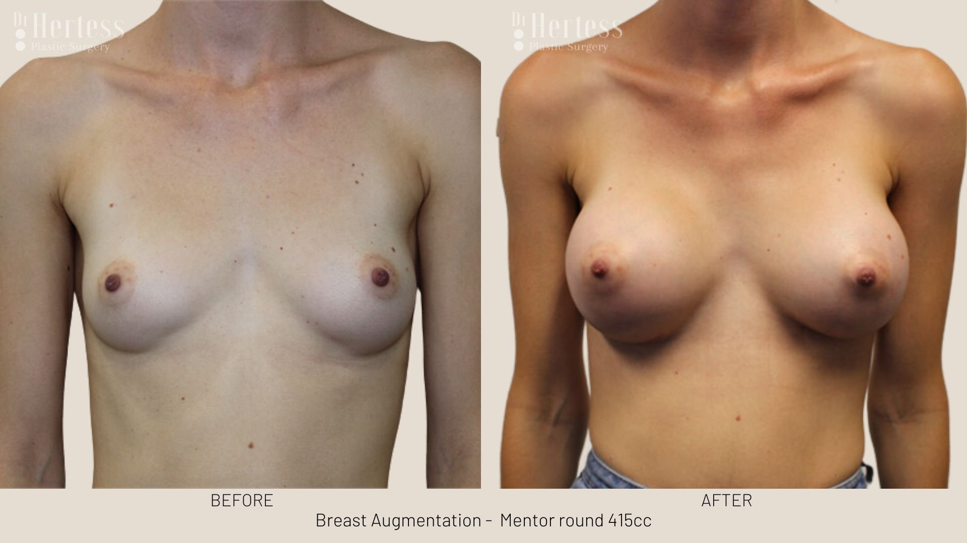 breast augmentation before and after