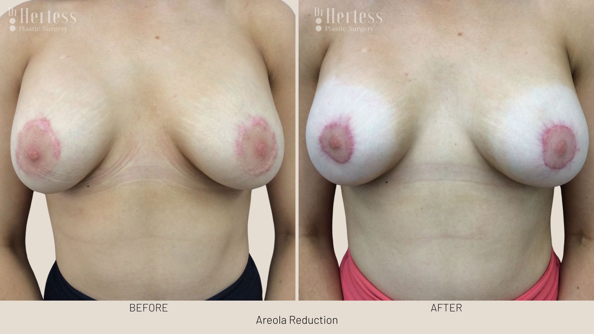 areola reduction